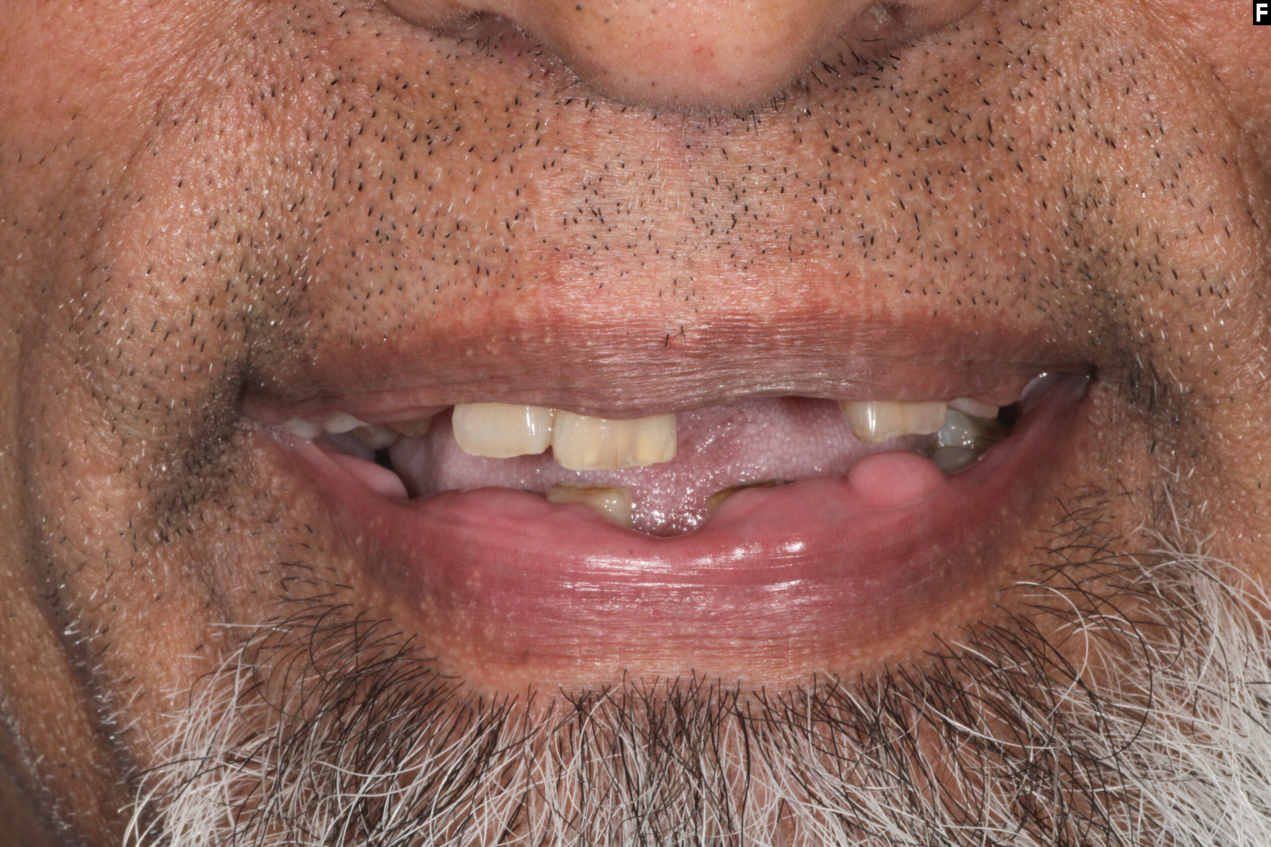dental implants baton rouge full mouth transformation dr andre bruni pearl dental group