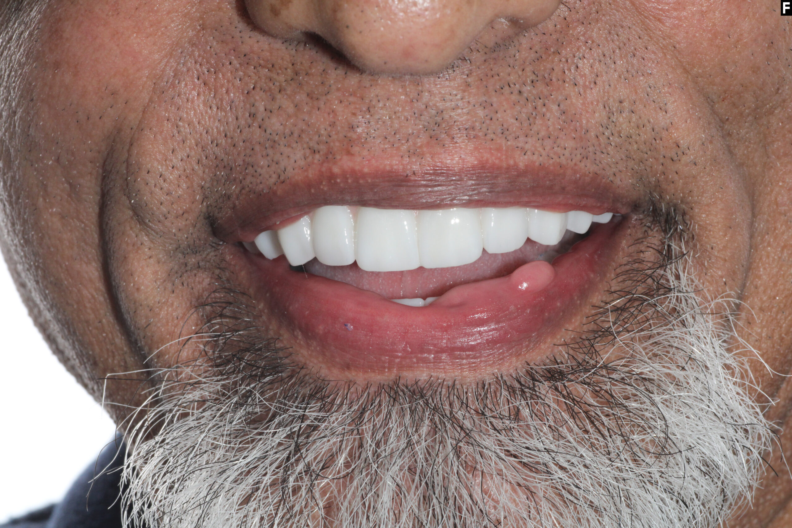 dental implants baton rouge full mouth transformation dr andre bruni pearl dental group