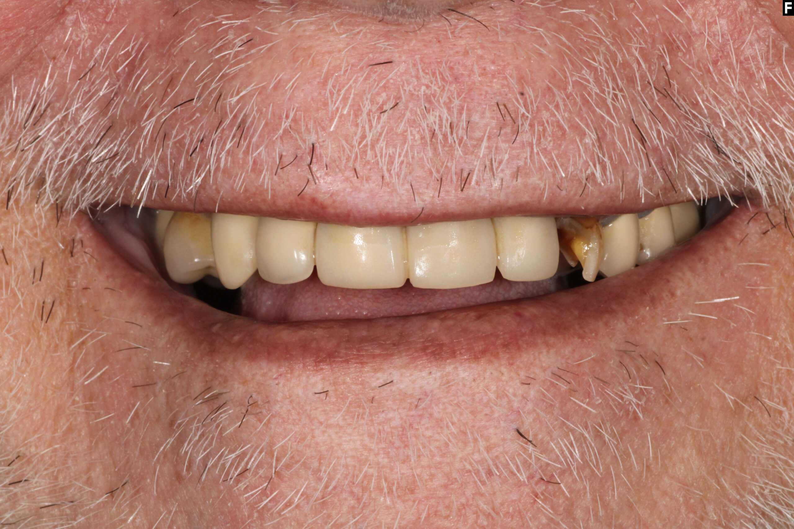same day dental implants baton rouge teeth in a day dr andre bruni