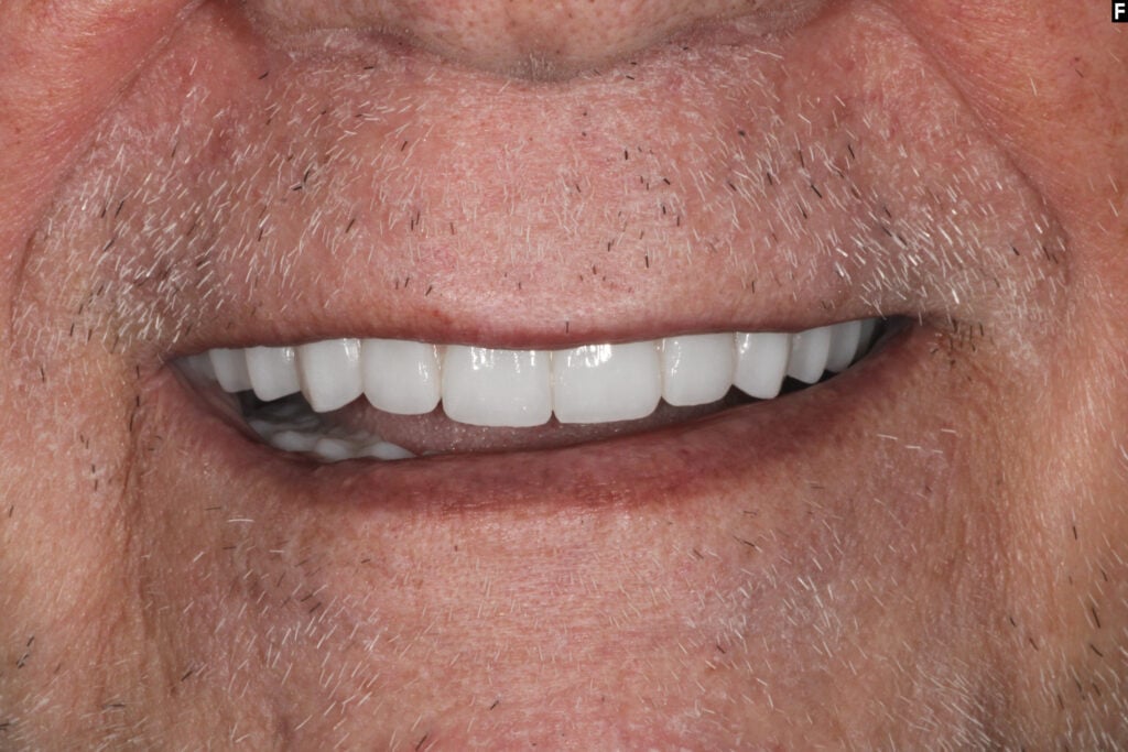 same day dental implants baton rouge teeth in a day dr andre bruni