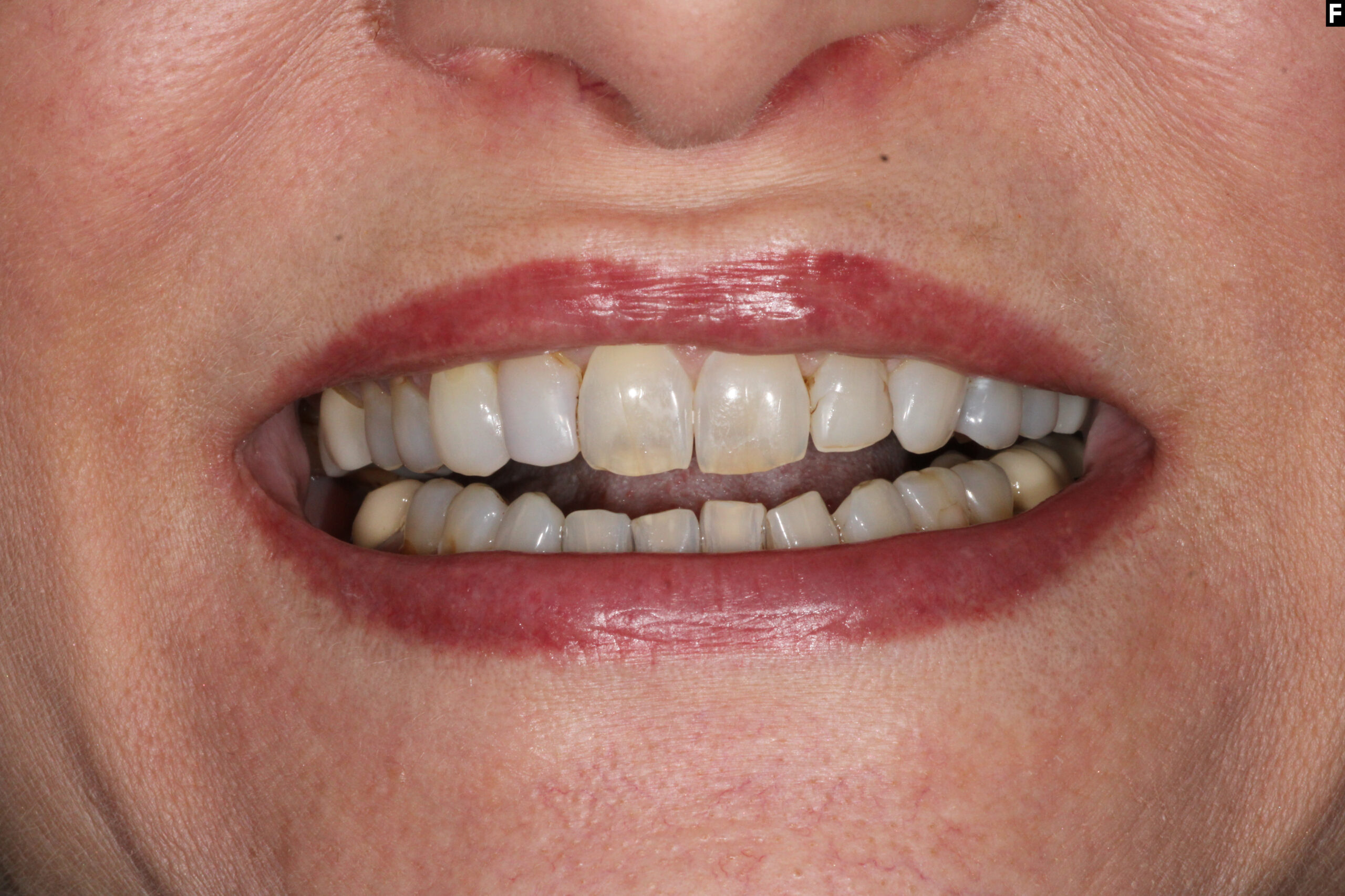 Full Smile Makeover with Zirconia Crowns Baton Rouge