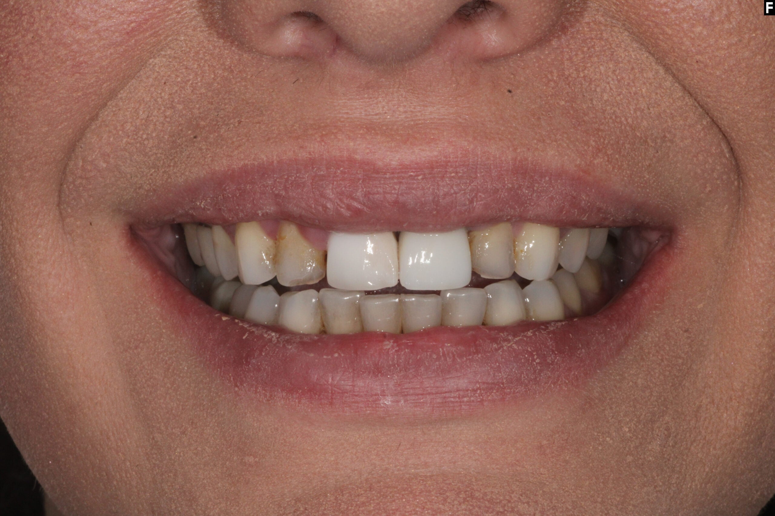 A natural-looking smile designed to match the patient’s face and personality.