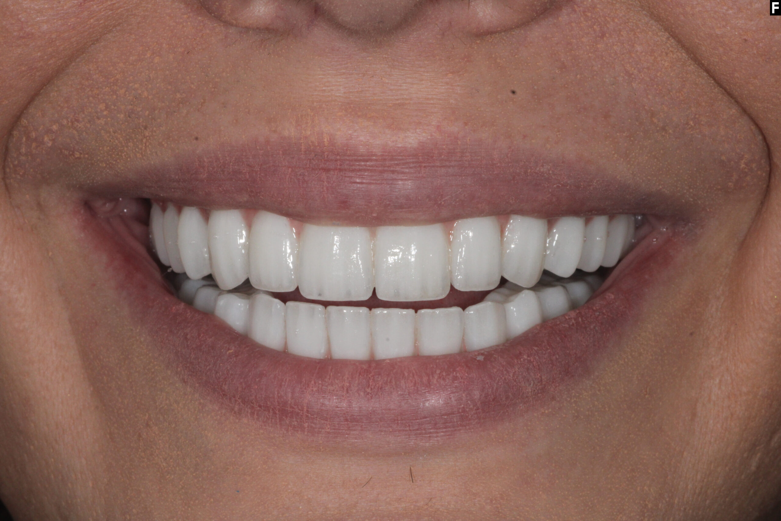 A natural-looking smile designed to match the patient’s face and personality.