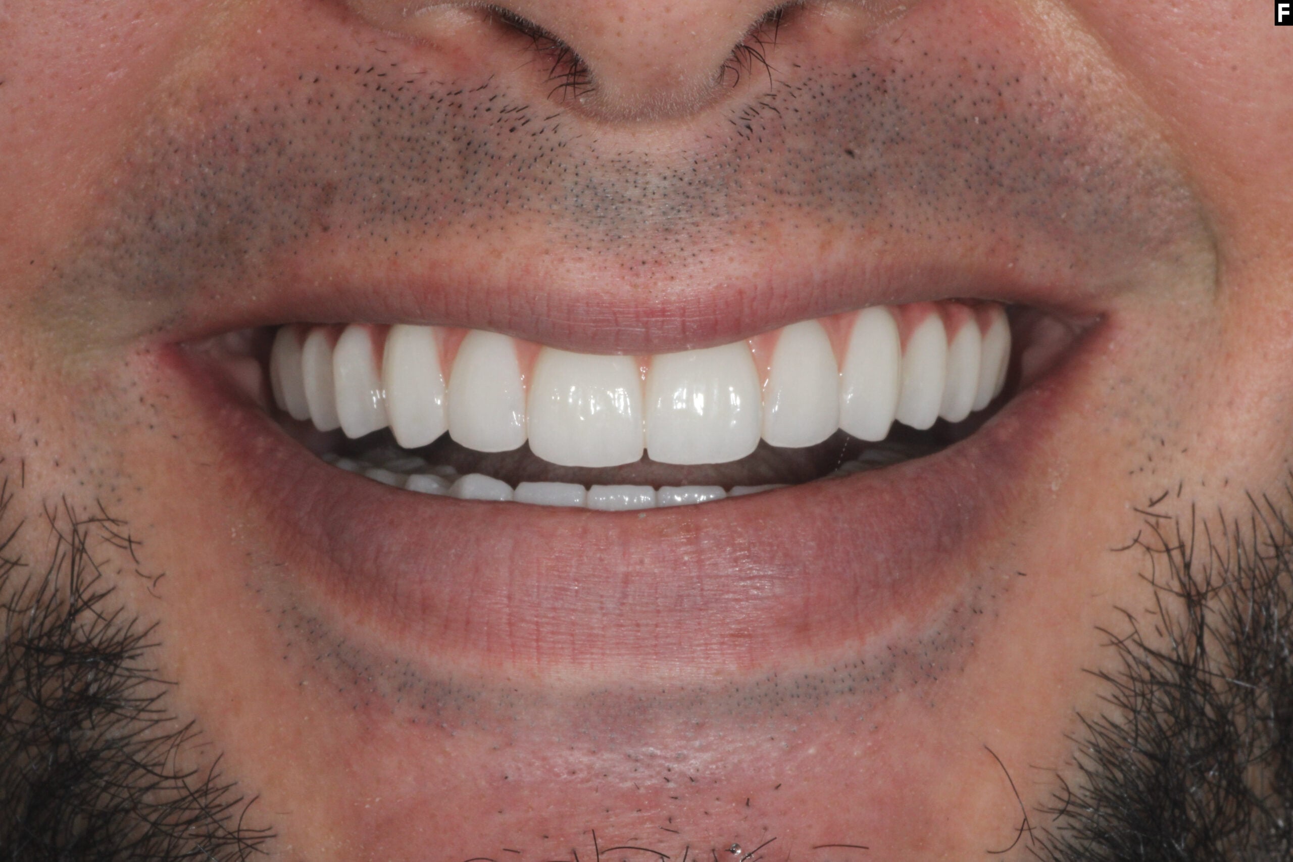After photo of full mouth dental implants with zirconia teeth by Dr. Andre Bruni at Pearl Dental Group in Baton Rouge