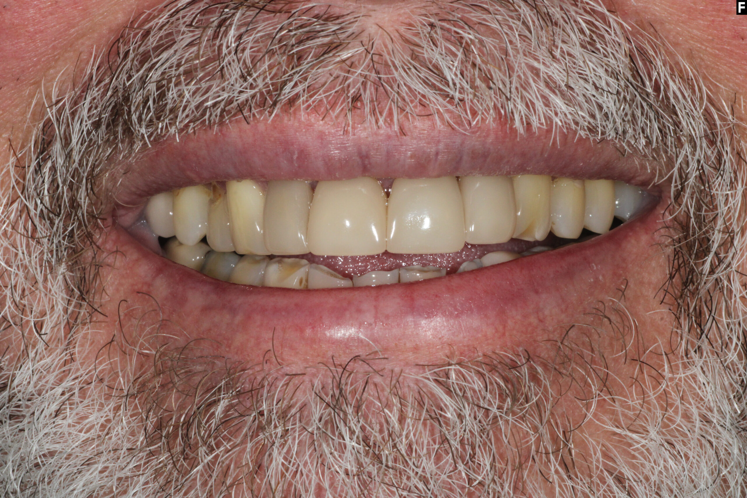 smile makeover baton rouge zirconia crowns full mouth reconstruction dr andre bruni