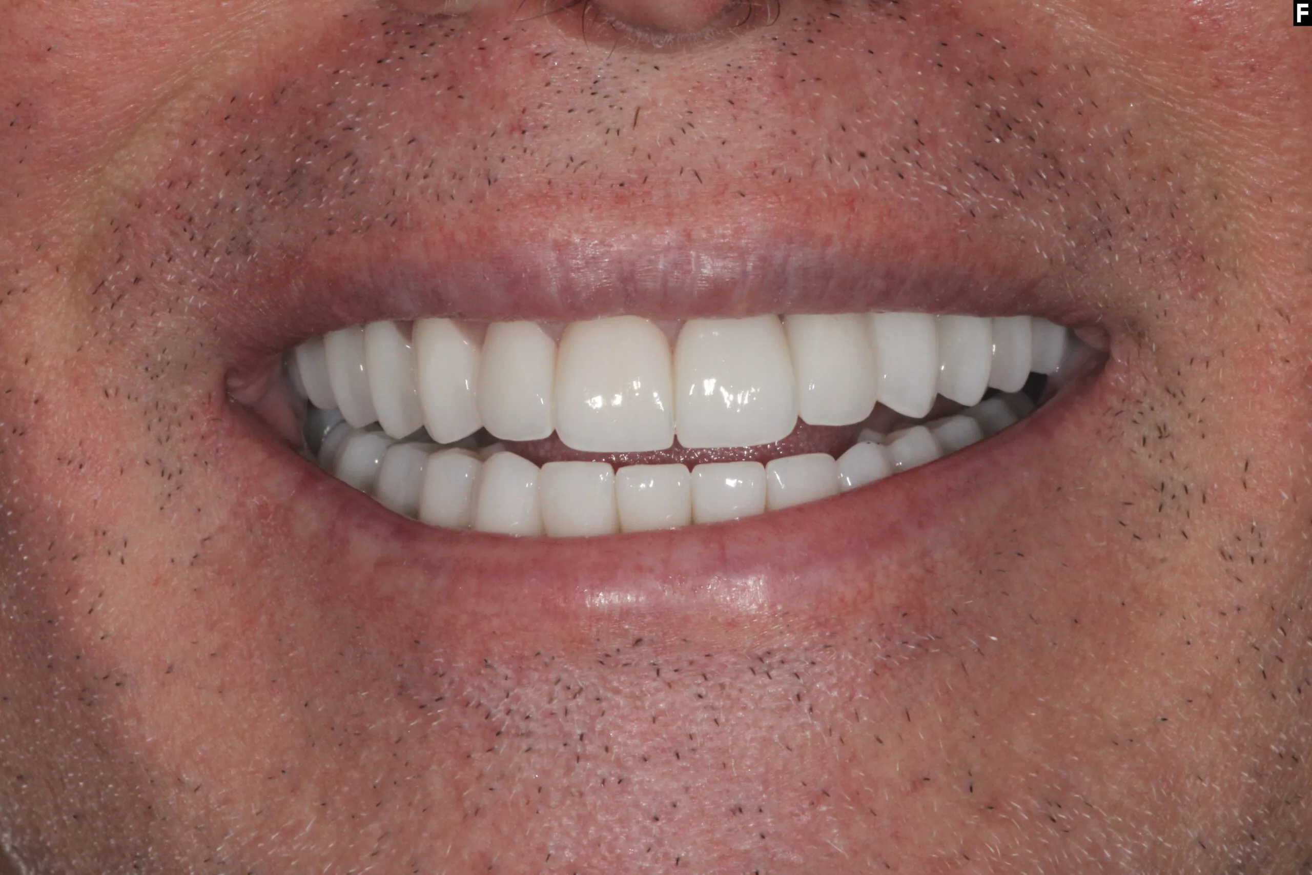 After full mouth zirconia crowns at Pearl Dental Group Baton Rouge