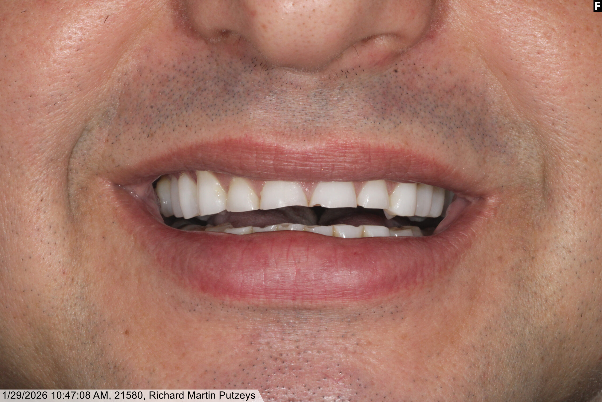 From severe wear to a healthy, confident smile.