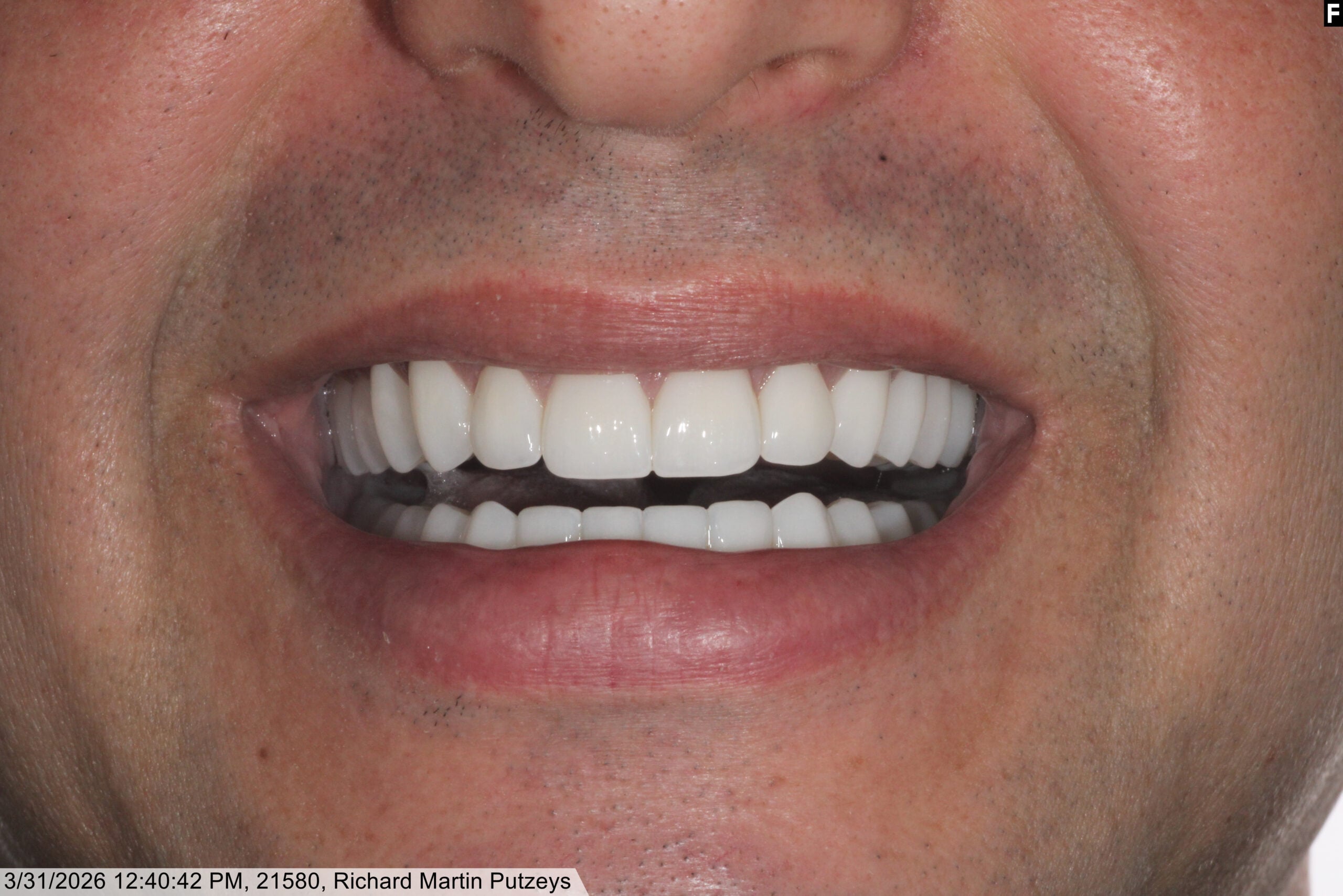 zirconia dental implants baton rouge full arch before after dr andre bruni
