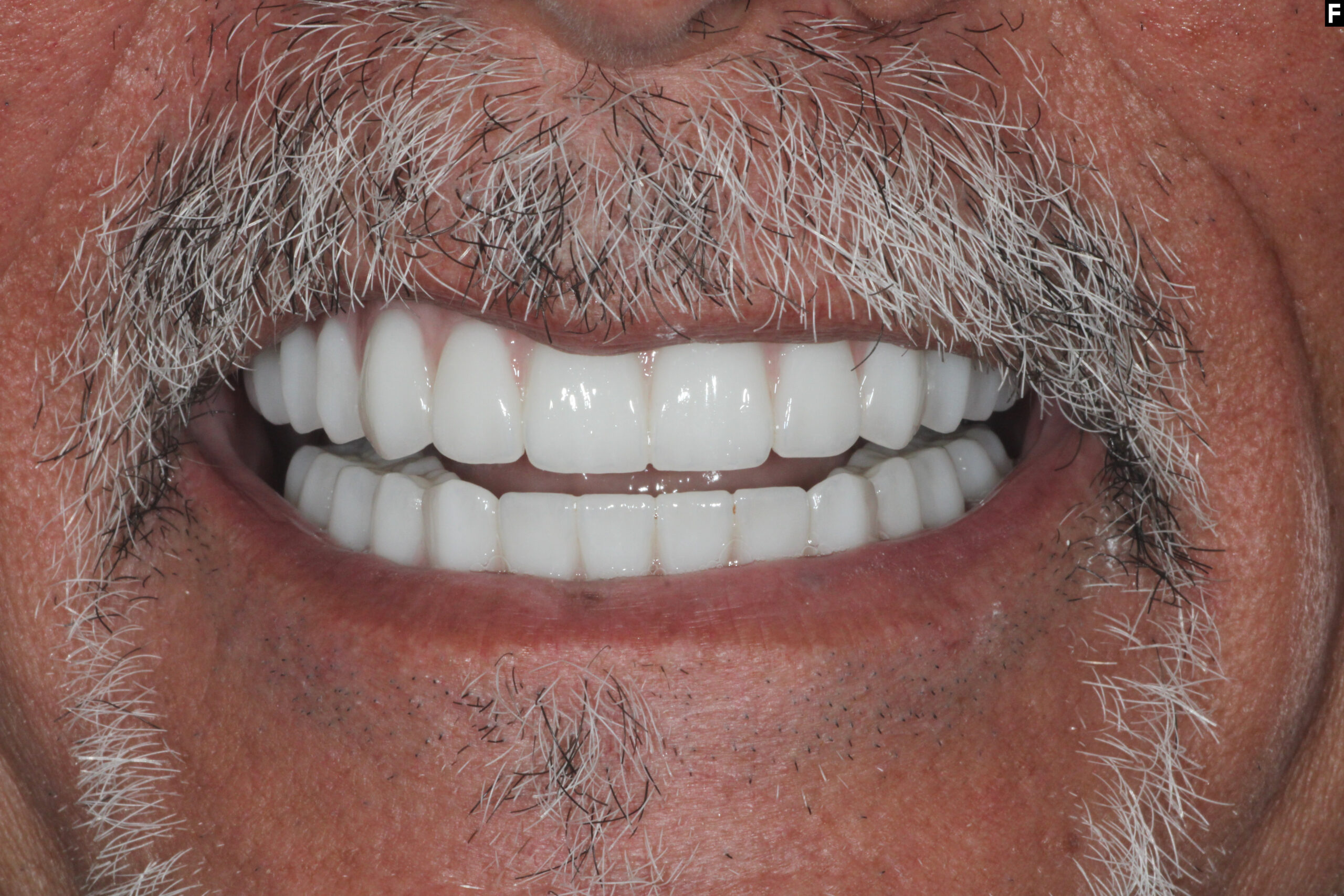 full mouth dental implants baton rouge dr andre bruni before after pearl dental group