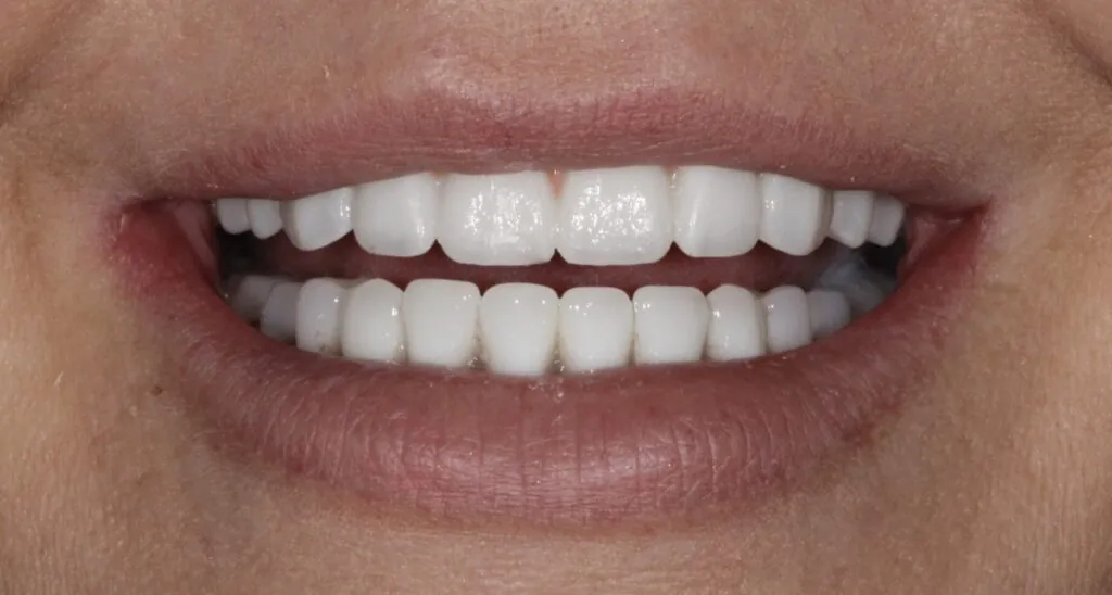 replace dentures with implants baton rouge zirconia full arch dr andre bruni