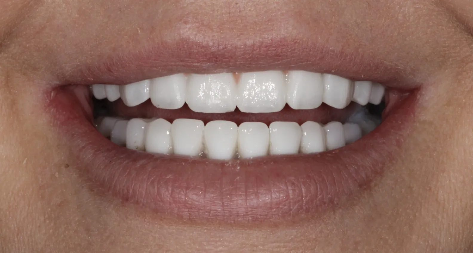 replace dentures with implants baton rouge zirconia full arch dr andre bruni