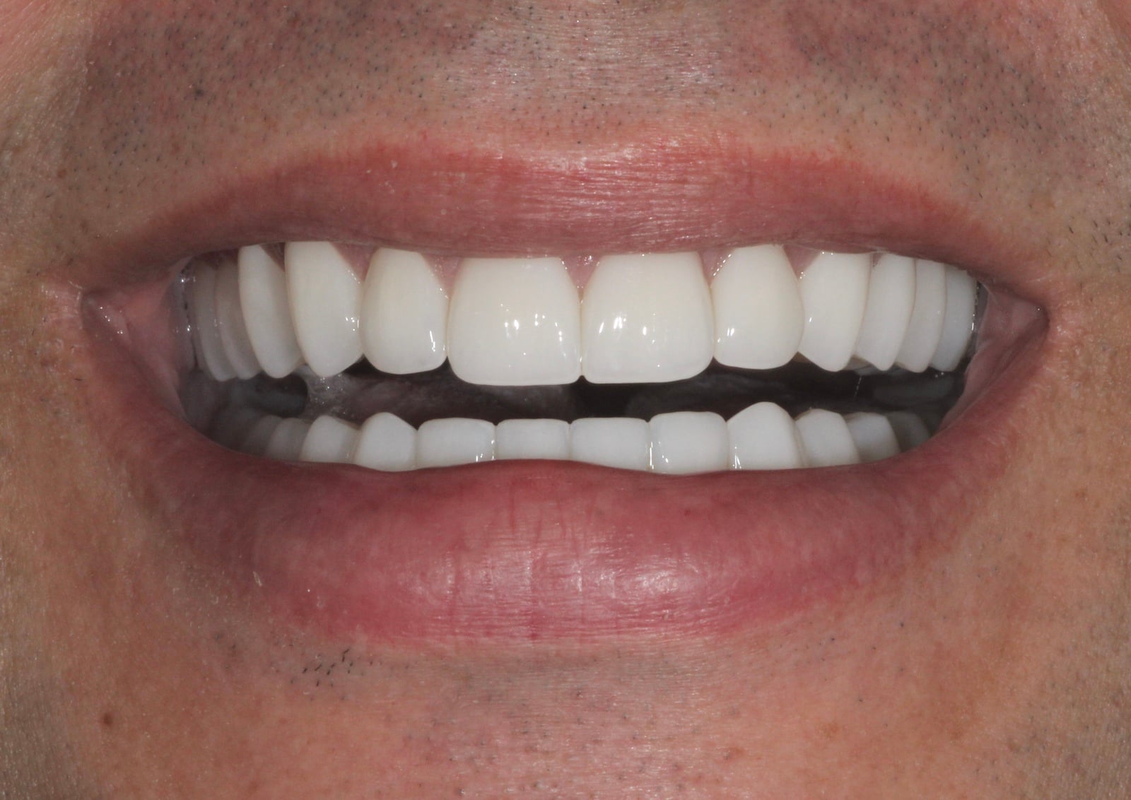 zirconia dental implants baton rouge full arch before after dr andre bruni