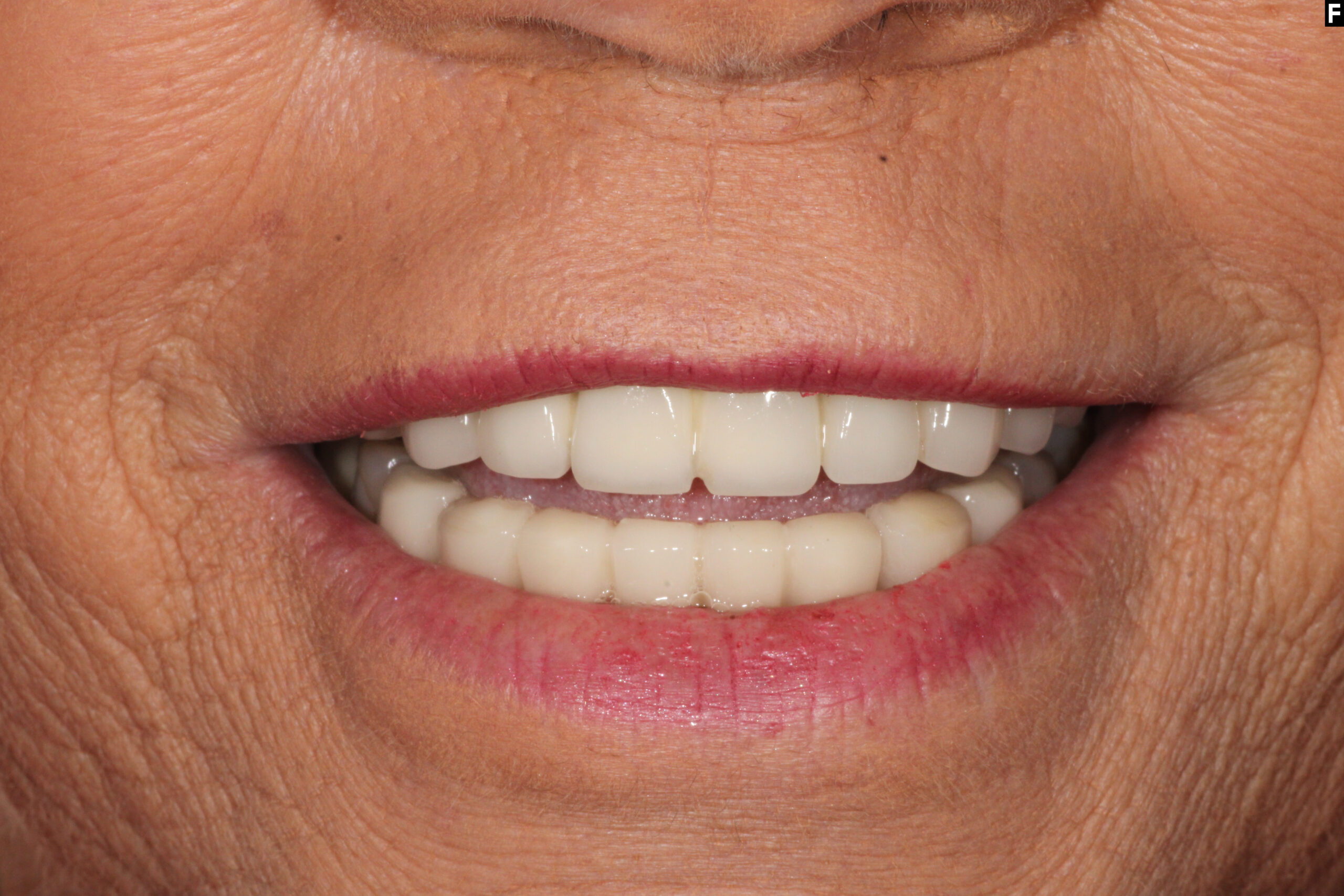zirconia dental implants baton rouge full arch before after dr andre bruni