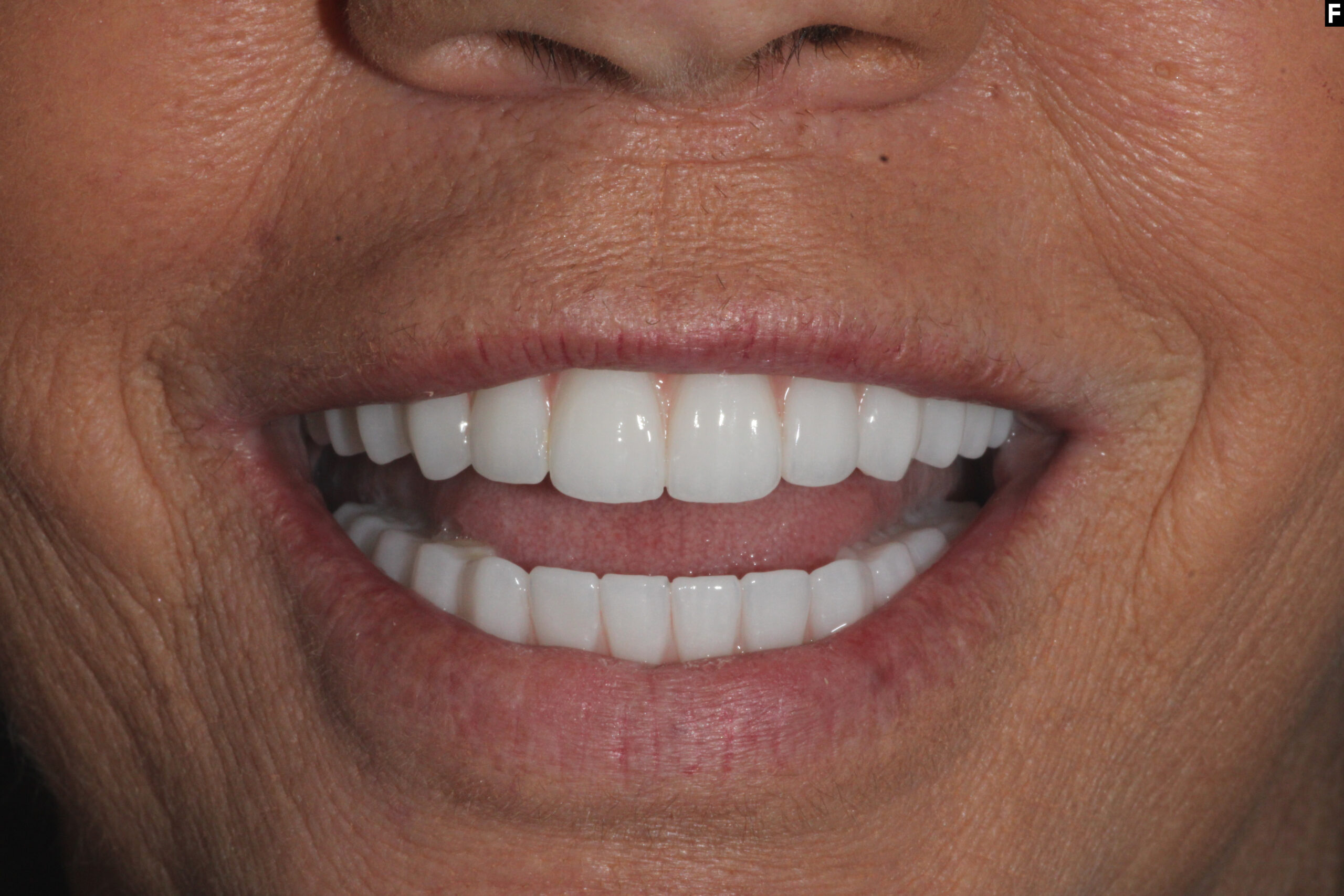 zirconia dental implants baton rouge full arch before after dr andre bruni