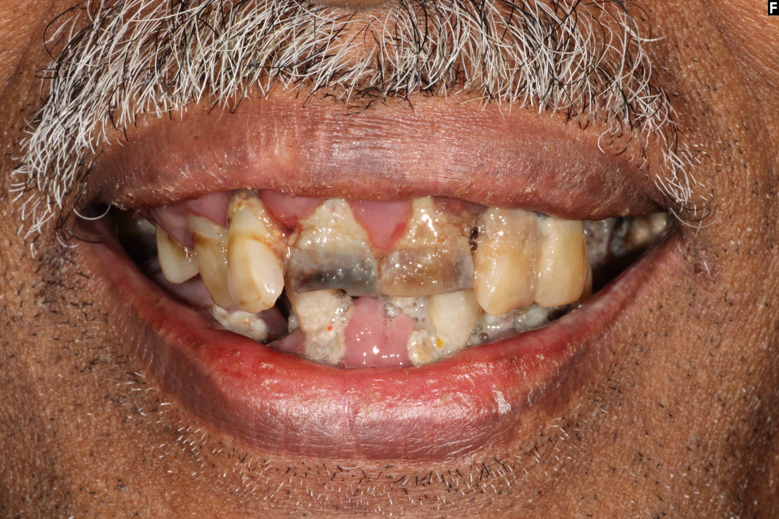A permanent solution for multiple missing or failing teeth.