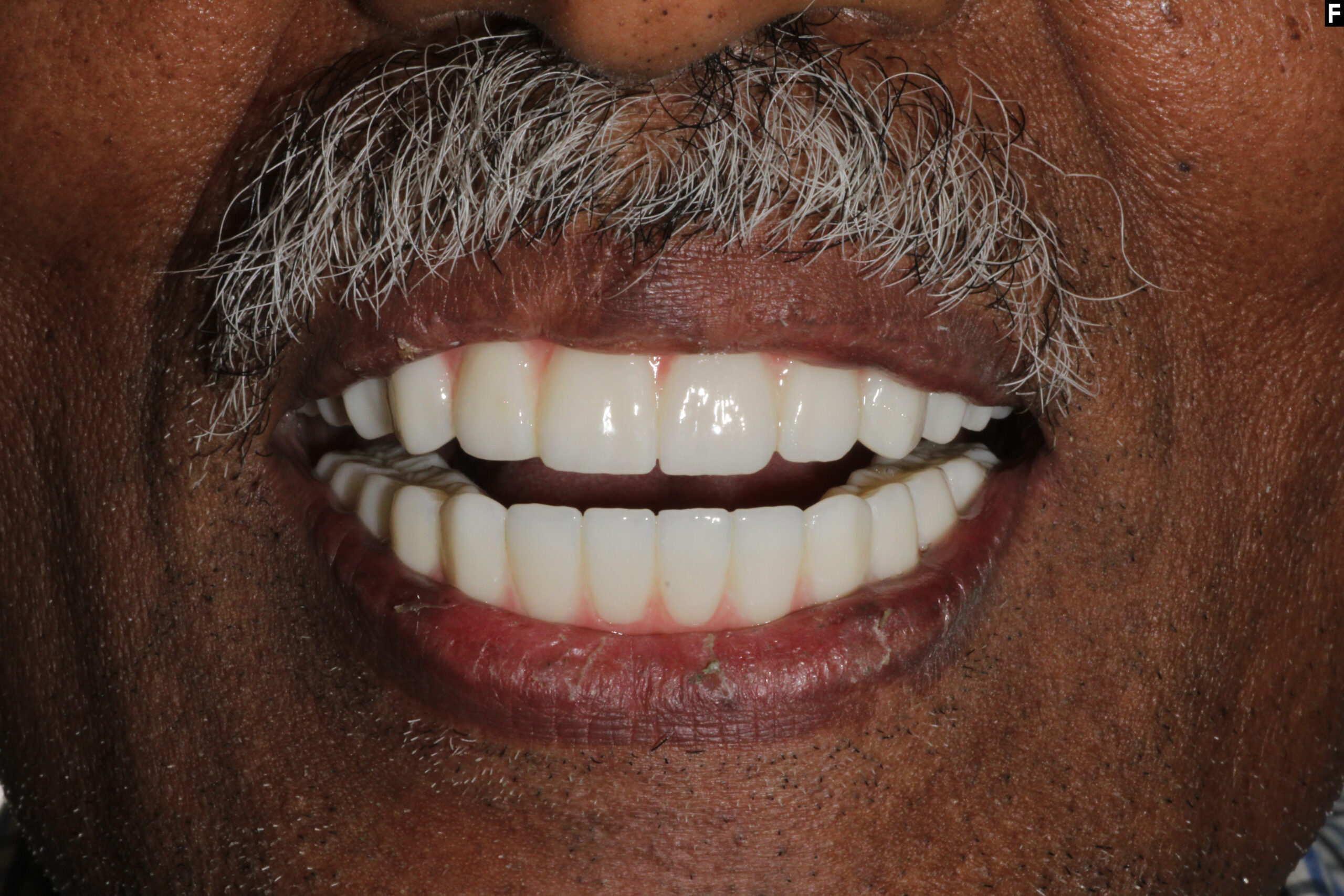 A permanent solution for multiple missing or failing teeth.