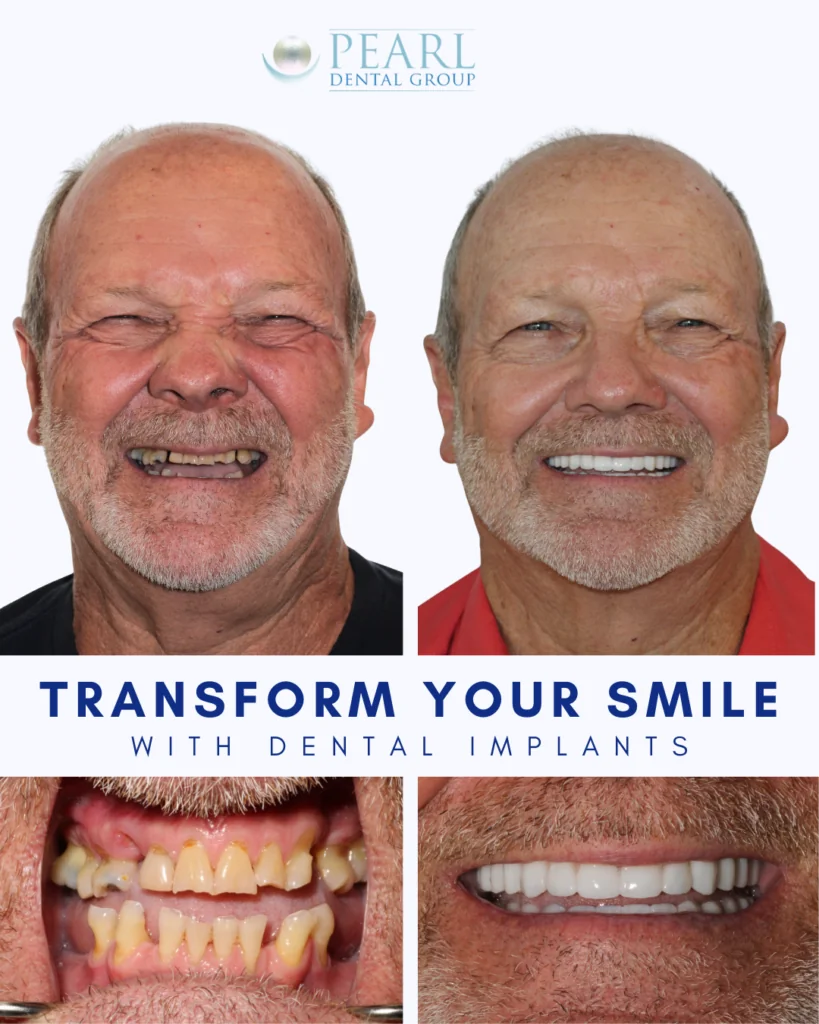 Before and after full mouth implant smile makeover for a patient with severe teeth grinding, failing teeth, and missing teeth restored with custom zirconia full arch dental implants at Pearl Dental Group in Baton Rouge, LA.