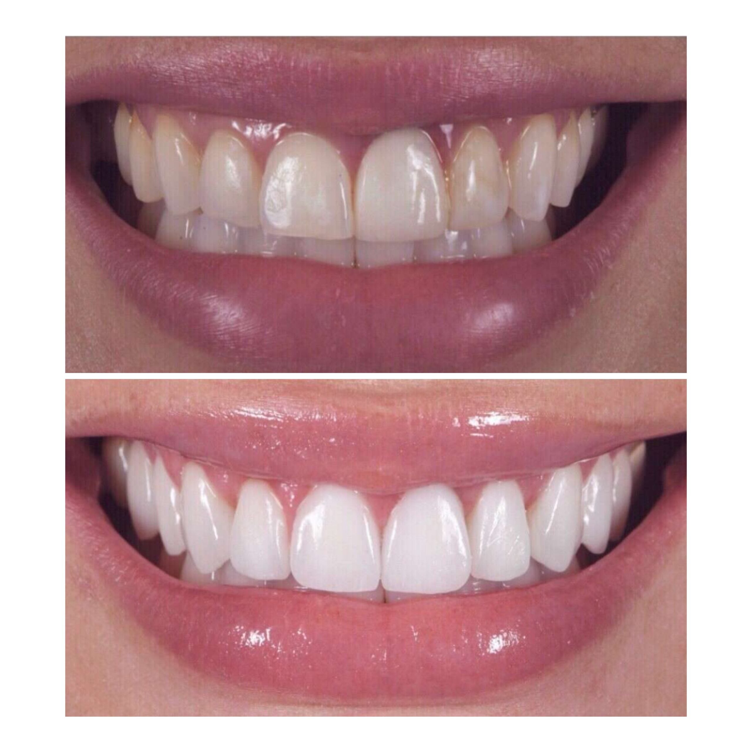 Before and after smile makeover showing stained uneven teeth transformed into a bright white smile with porcelain veneers by Dr. Andre Bruni at Pearl Dental Group in Baton Rouge.