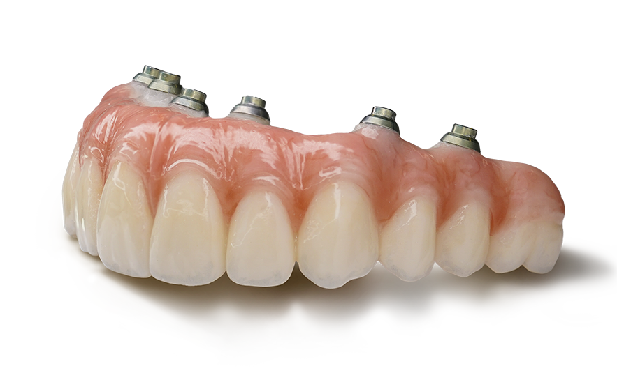 Monolithic zirconia full arch dental implant prosthesis displayed outside the mouth, showcasing a custom-designed fixed bridge used for All-on-4 and full mouth dental implant restorations at Pearl Dental Group in Baton Rouge.