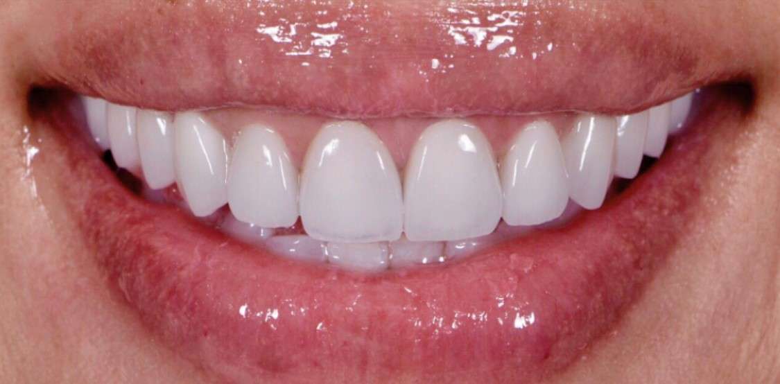 Close-up of a bright natural-looking smile enhanced with porcelain veneers.