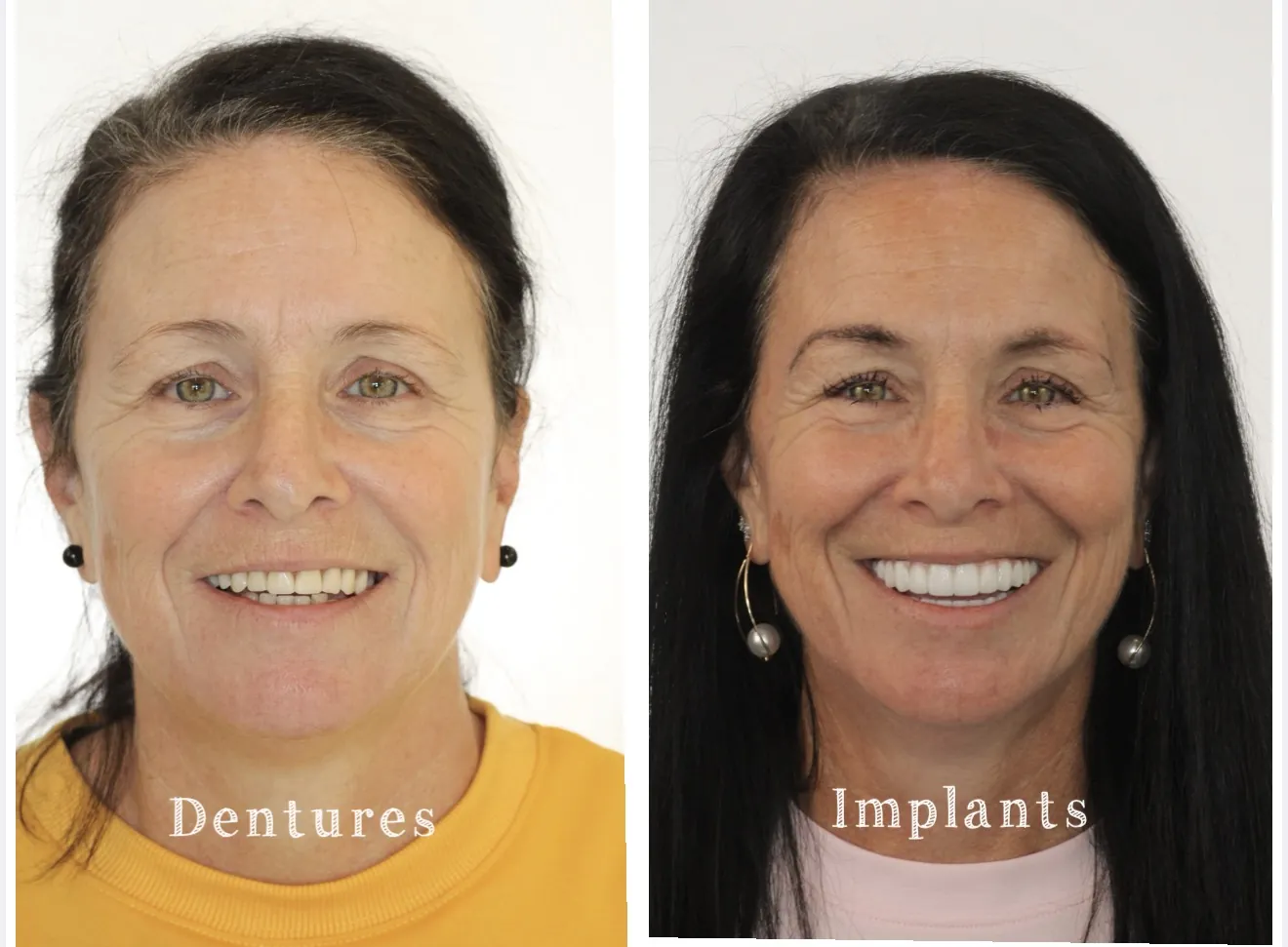 Patient before and after full mouth dental implants replacing dentures with a natural-looking zirconia smile at [Pearl Dental Group](https://www.pearldentalgroup.com?utm_source=chatgpt.com) in Baton Rouge, LA. Full face transformation showing improved smile, facial support, and confidence after All-on-X dental implant treatment.