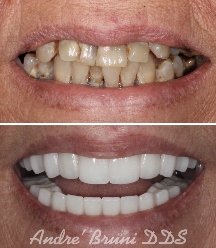 Before and after full mouth dental implants by Dr. Andre Bruni at Pearl Dental Group in Baton Rouge, transforming failing teeth into a beautiful, natural-looking permanent zirconia smile.