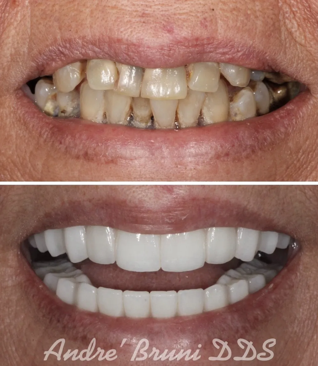 Before and after full mouth dental implants by Dr. Andre Bruni at Pearl Dental Group in Baton Rouge, transforming failing teeth into a beautiful, natural-looking permanent zirconia smile.