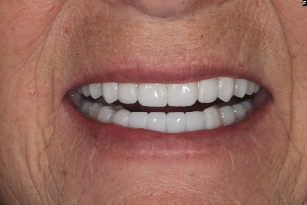 After full mouth dental implants: restored smile, Pearl Dental Group