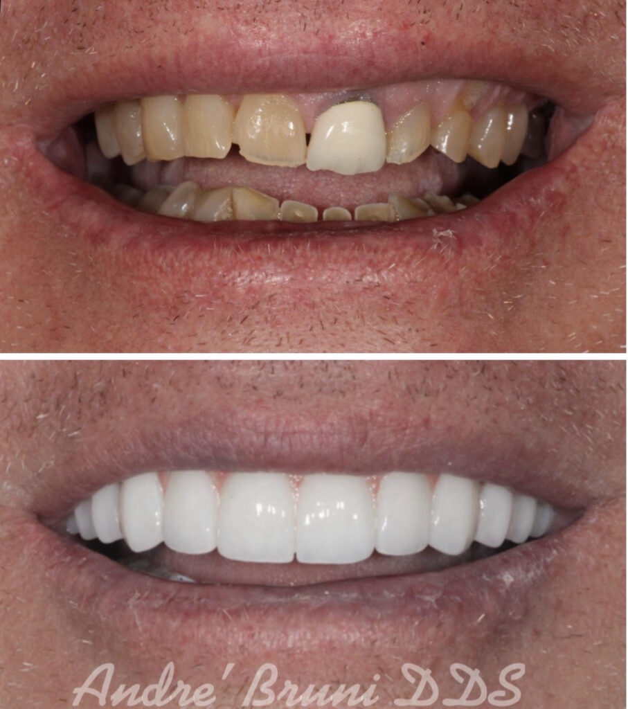 Before and after full mouth dental implant transformation showing worn, failing teeth replaced with a natural-looking zirconia smile by Dr. Andre Bruni at Pearl Dental Group in Baton Rouge.