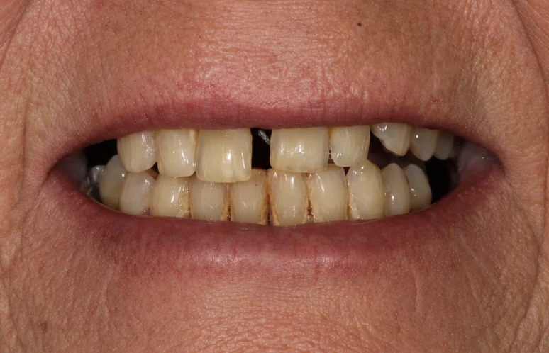Dental Implant Before Photo | Pearl Dental Group Baton Rouge Before photo showing missing and damaged teeth prior to dental implant treatment in Baton Rouge
