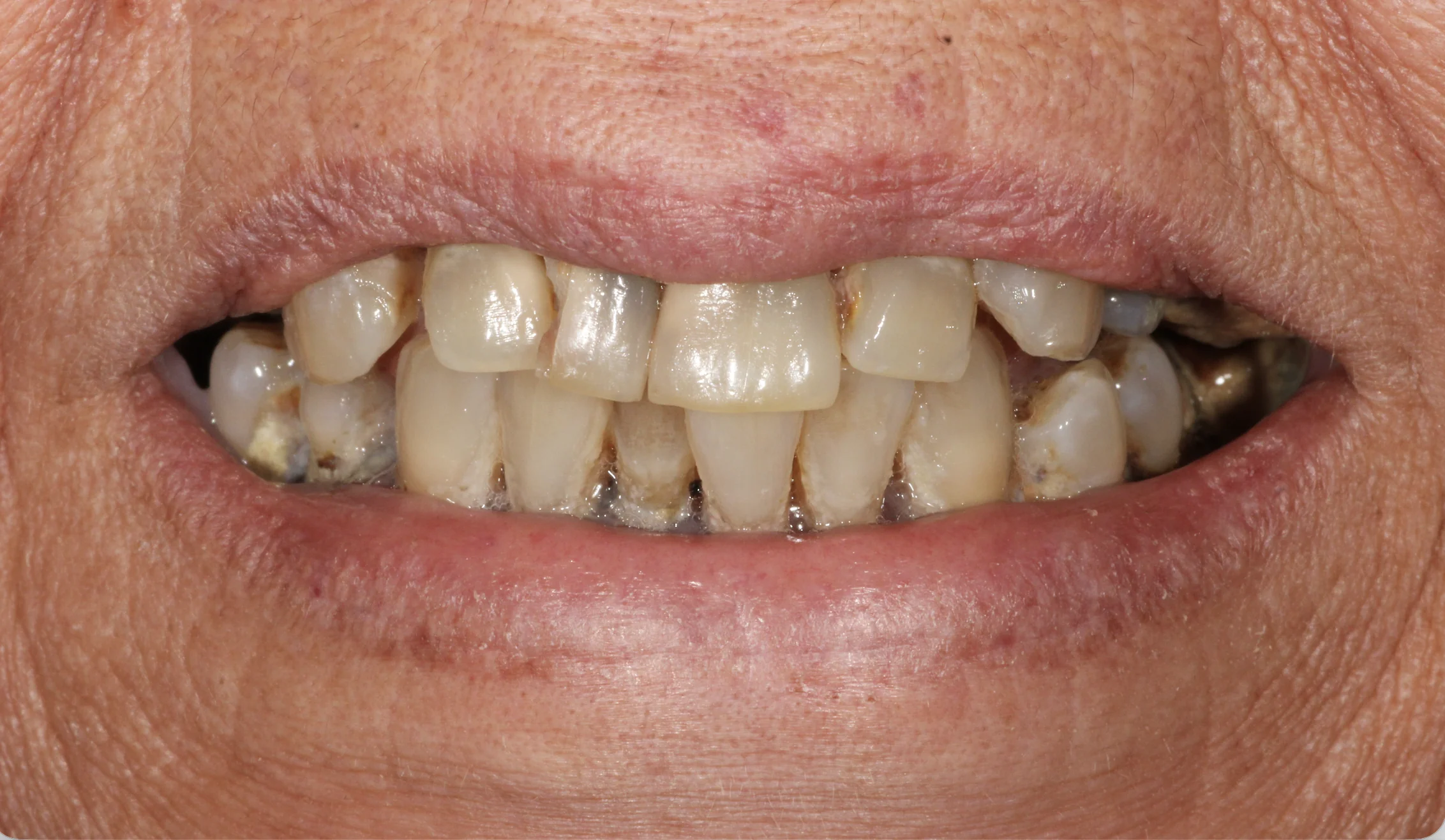 Full Mouth Dental Treatment Before Photo | Pearl Dental Group Baton Rouge Patient before full mouth dental treatment at Pearl Dental Group in Baton Rouge