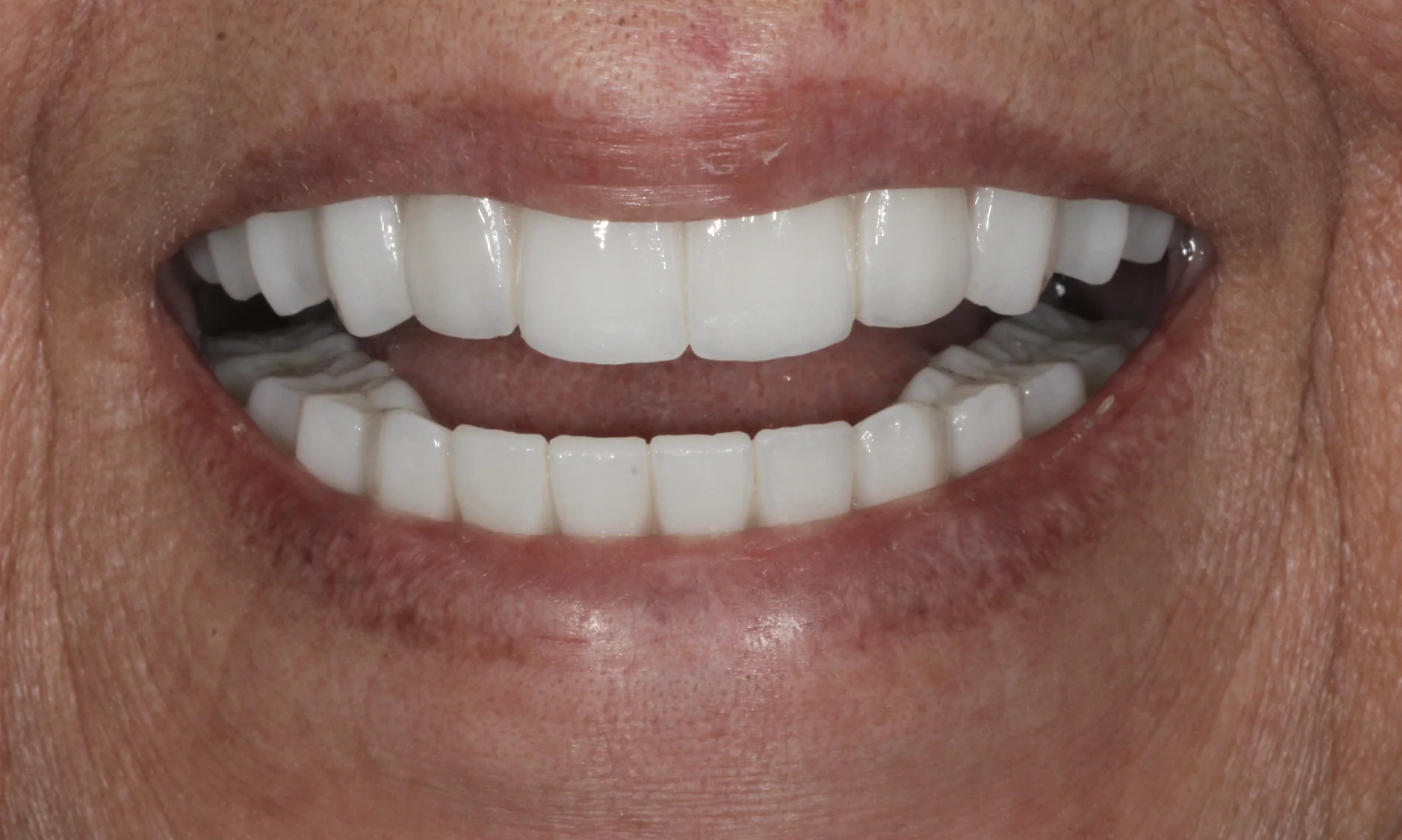 Patient after full mouth dental