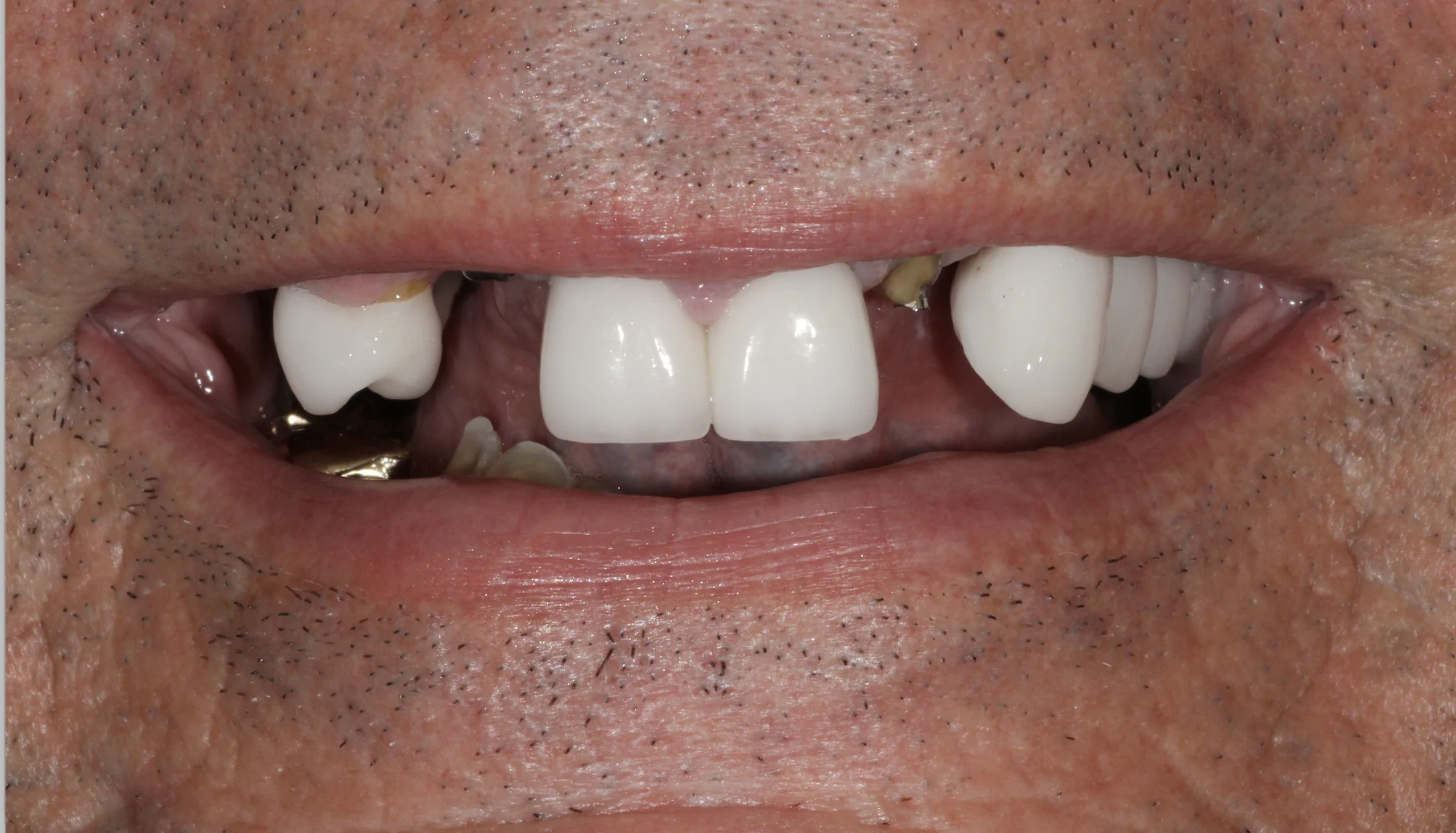 Full Mouth Dental Implants Before Photo | Pearl Dental Group Baton Rouge Before full mouth dental implants showing missing and failing teeth in Baton Rouge