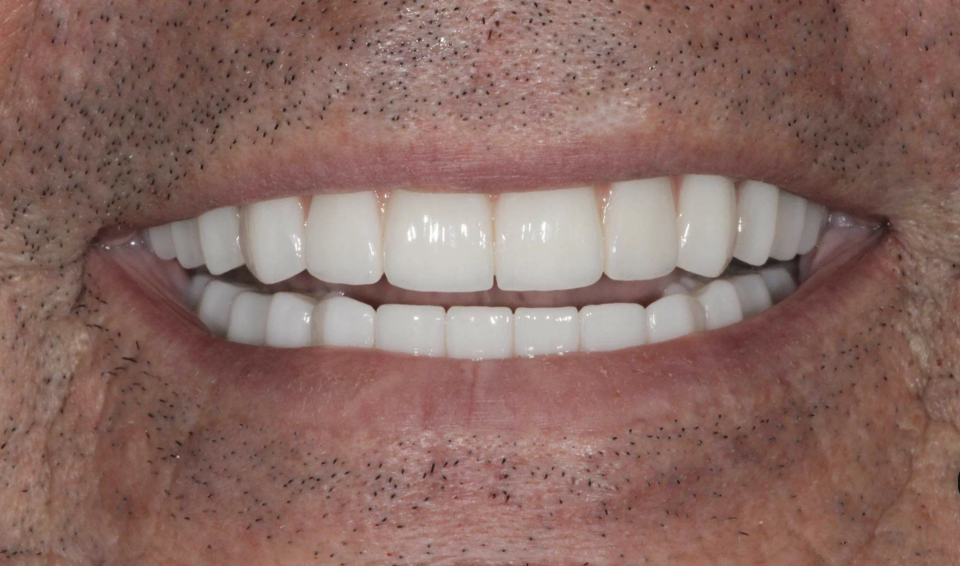 After full mouth dental implants showing restored smile in Baton Rouge