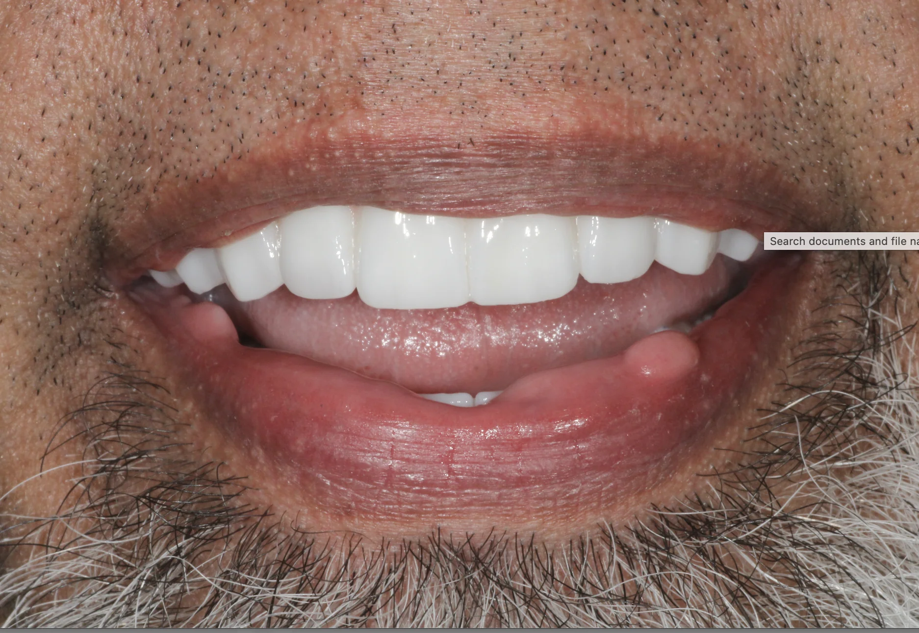 dental implants baton rouge full mouth