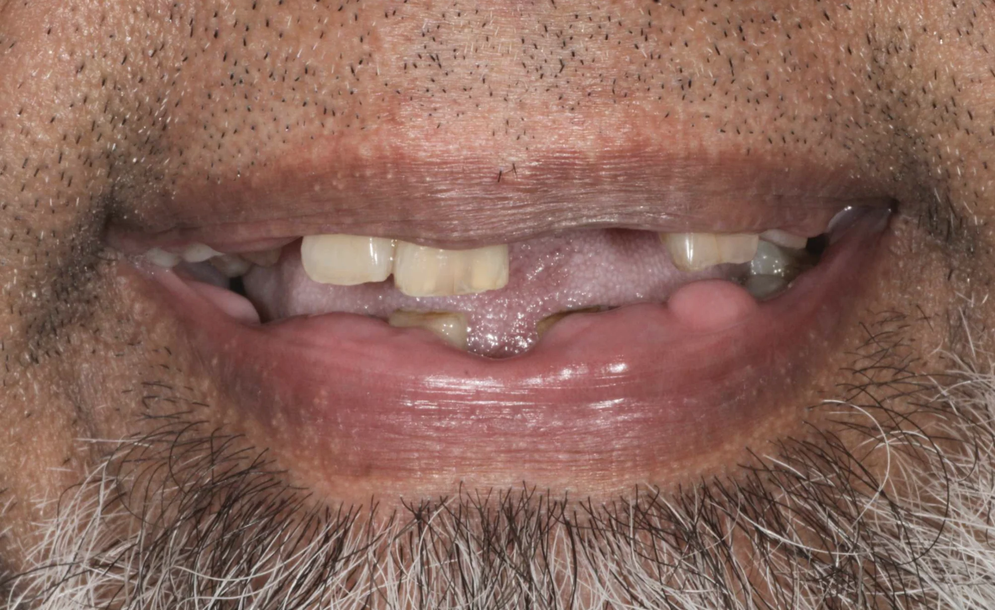Same-Day Dental Implants – Real Patient Results dental implants baton rouge full mouth