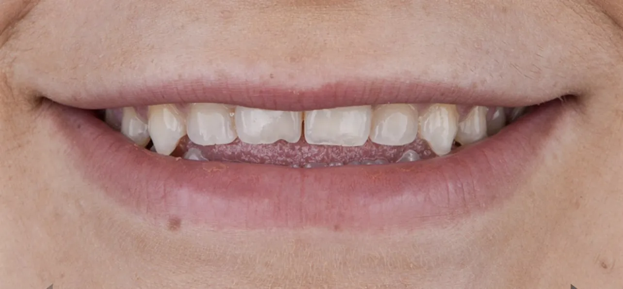 Discolored teeth before a smile makeover at Pearl Dental Group in Metairie, LA