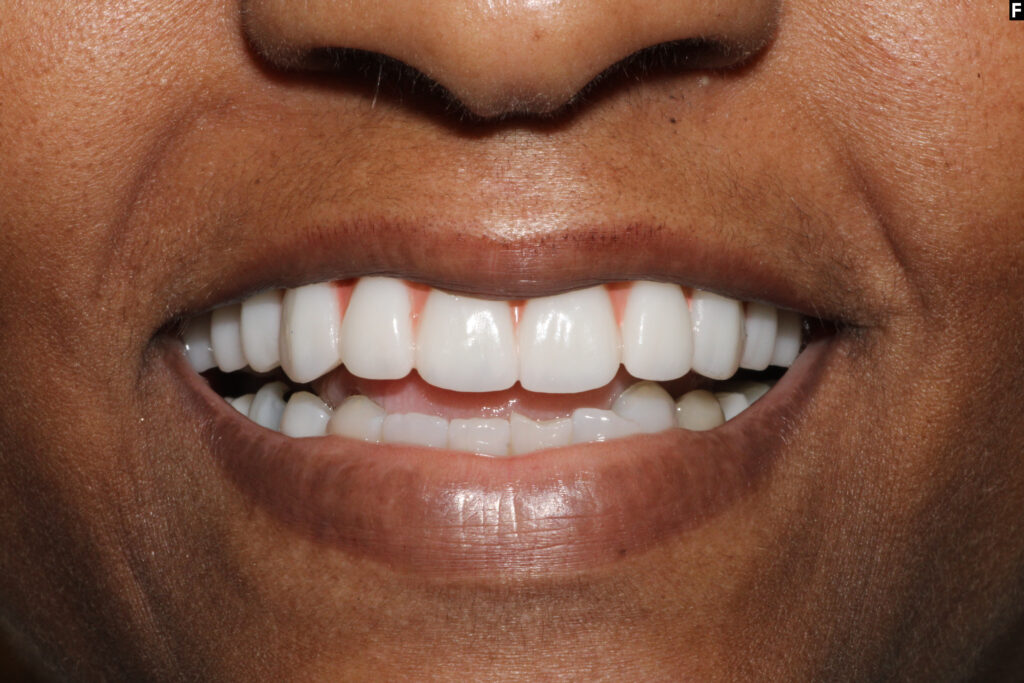 All on 4 Dental Implants -Pearl Dental Group- Metairie