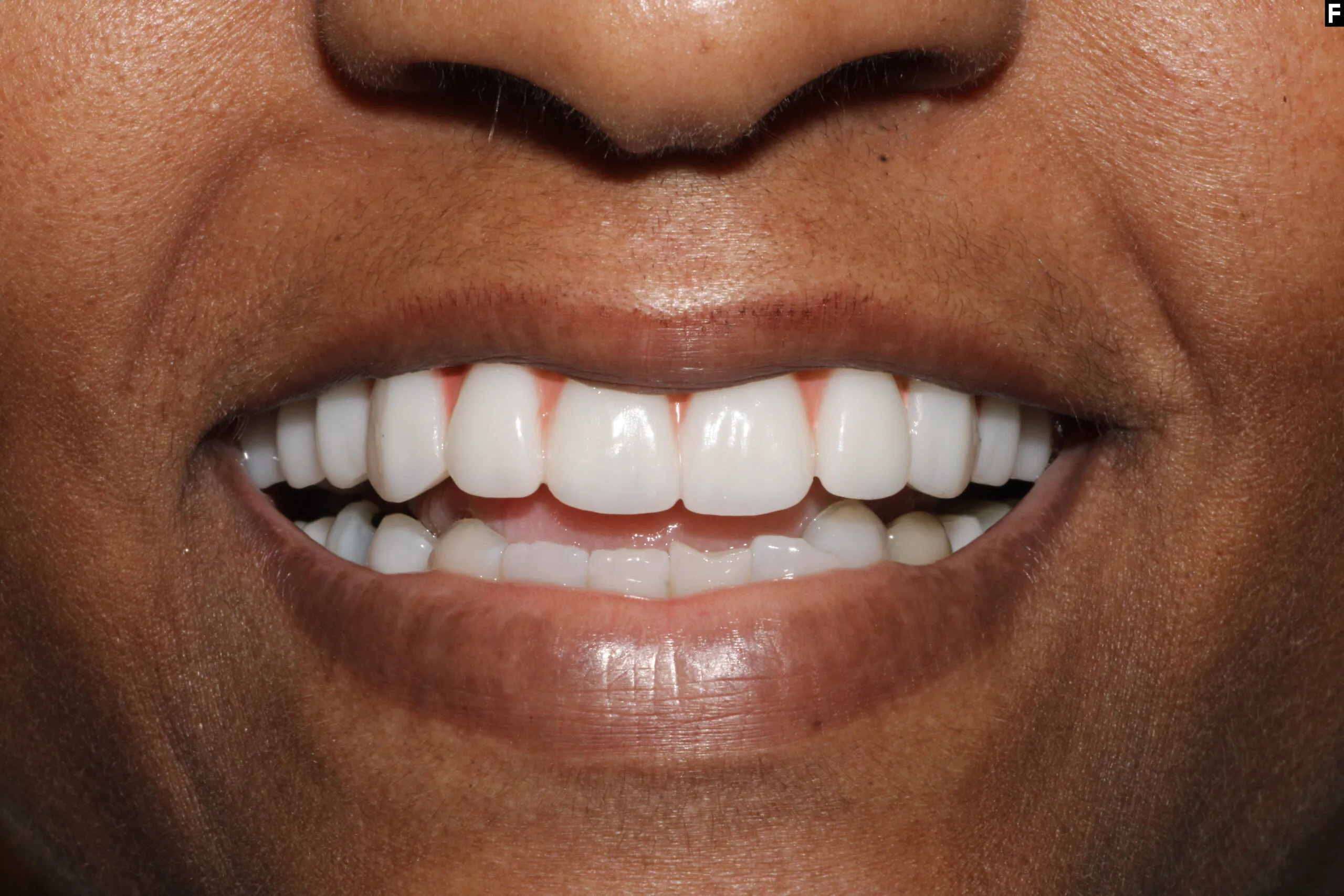 All on 4 Dental Implants -Pearl Dental Group- Metairie
