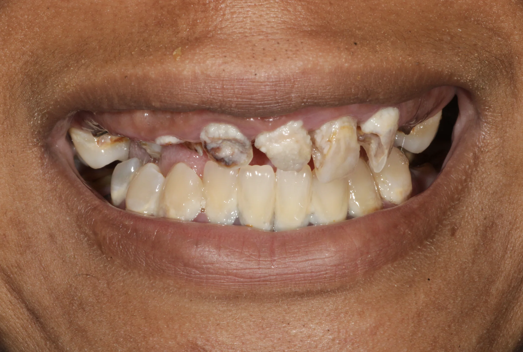Before full mouth dental implant treatment at Pearl Dental Group in Metairie, LA.