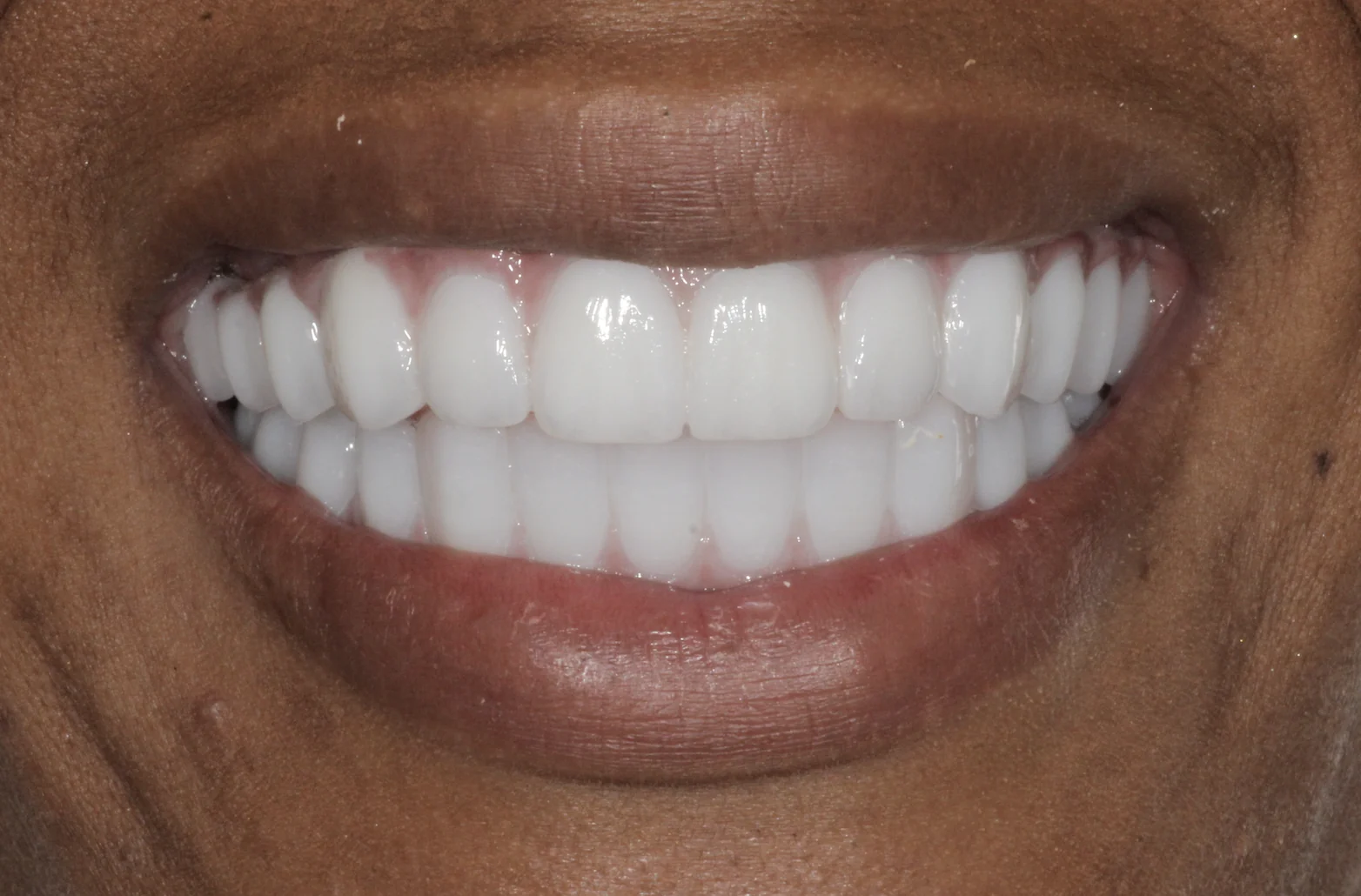 Full mouth dental implants restoring upper and lower teeth at Pearl Dental Group in Metairie, LA