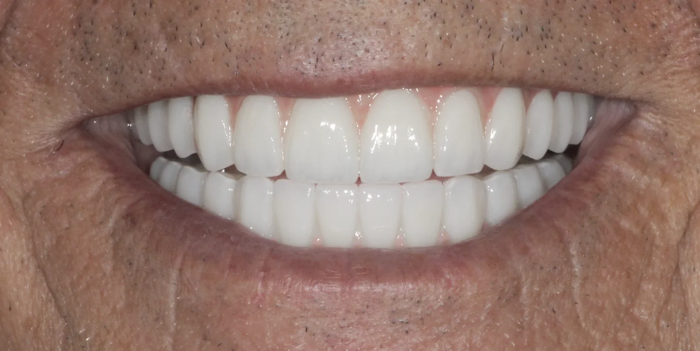 Restored upper and lower smile after full mouth dental implant treatment at Pearl Dental Group in Metairie, LA