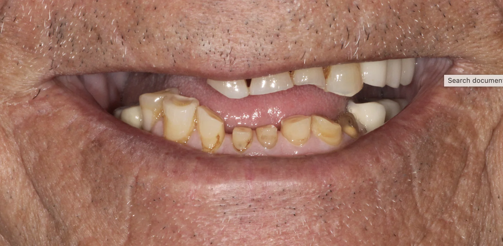 Severely worn and broken upper and lower teeth before full mouth dental implants at Pearl Dental Group in Metairie, LA