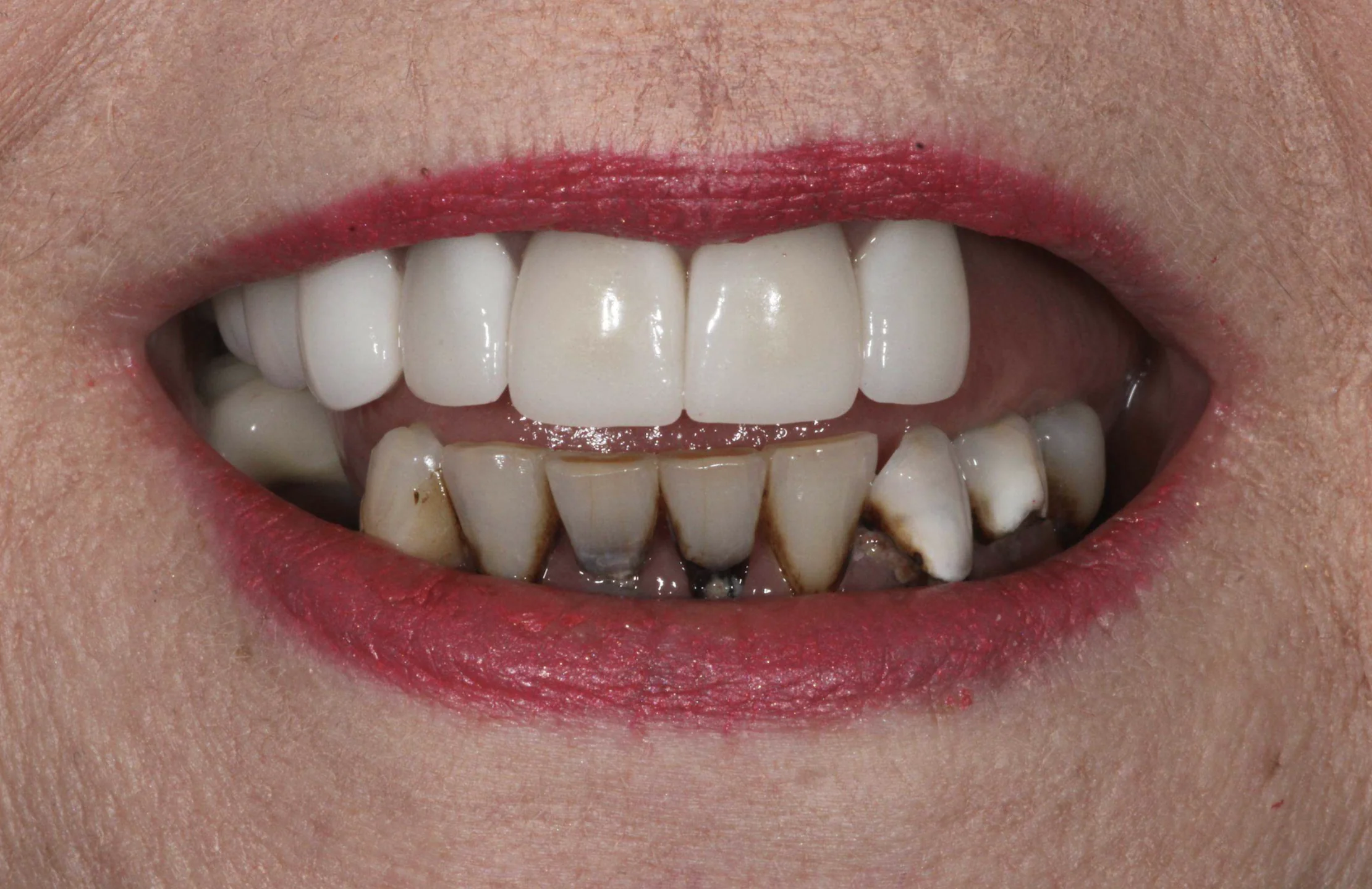 Decayed and missing upper and lower teeth before full mouth dental implants at Pearl Dental Group in Metairie, LA