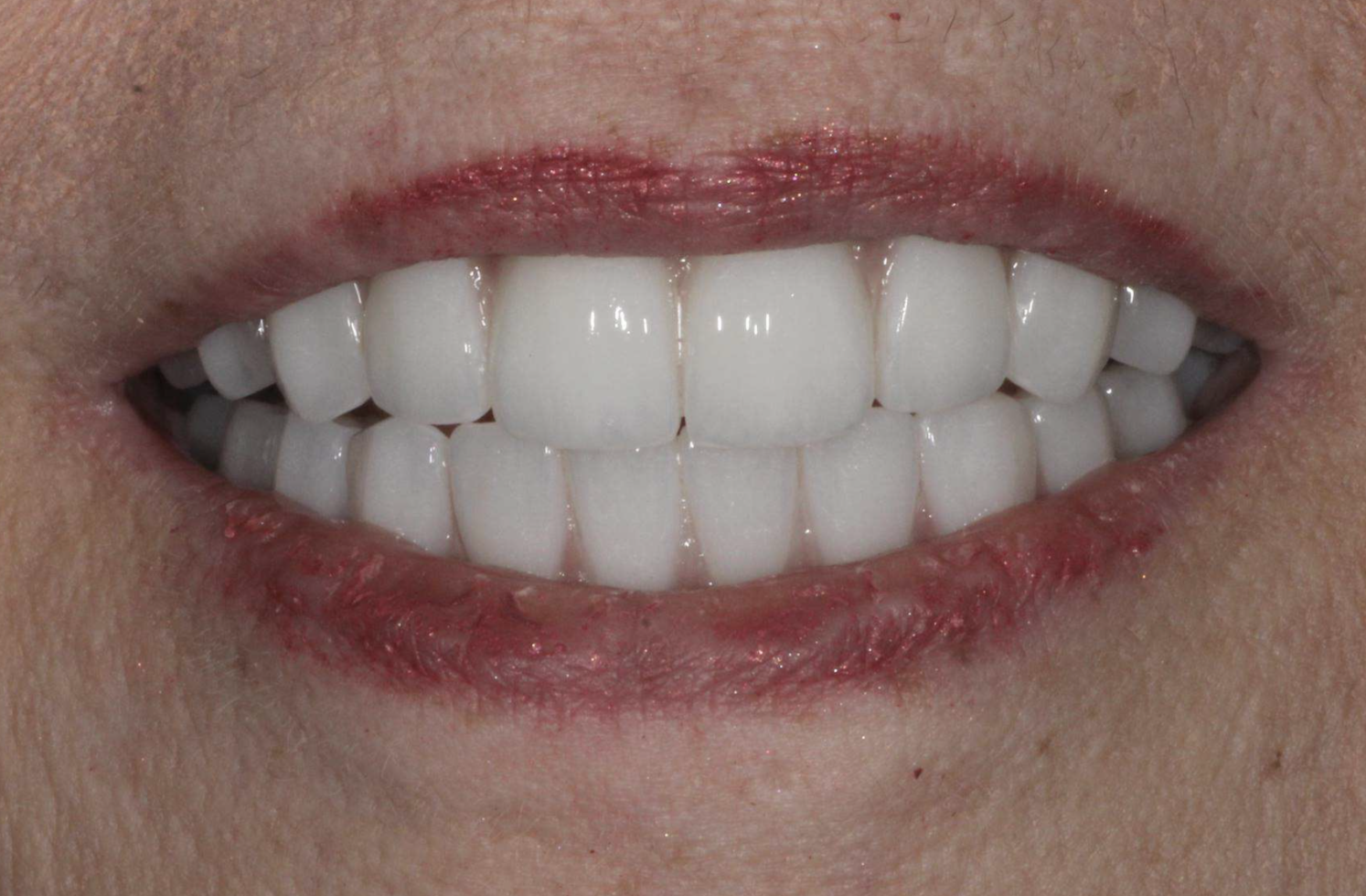 Restored upper and lower teeth after full mouth dental implant treatment at Pearl Dental Group in Metairie, LA