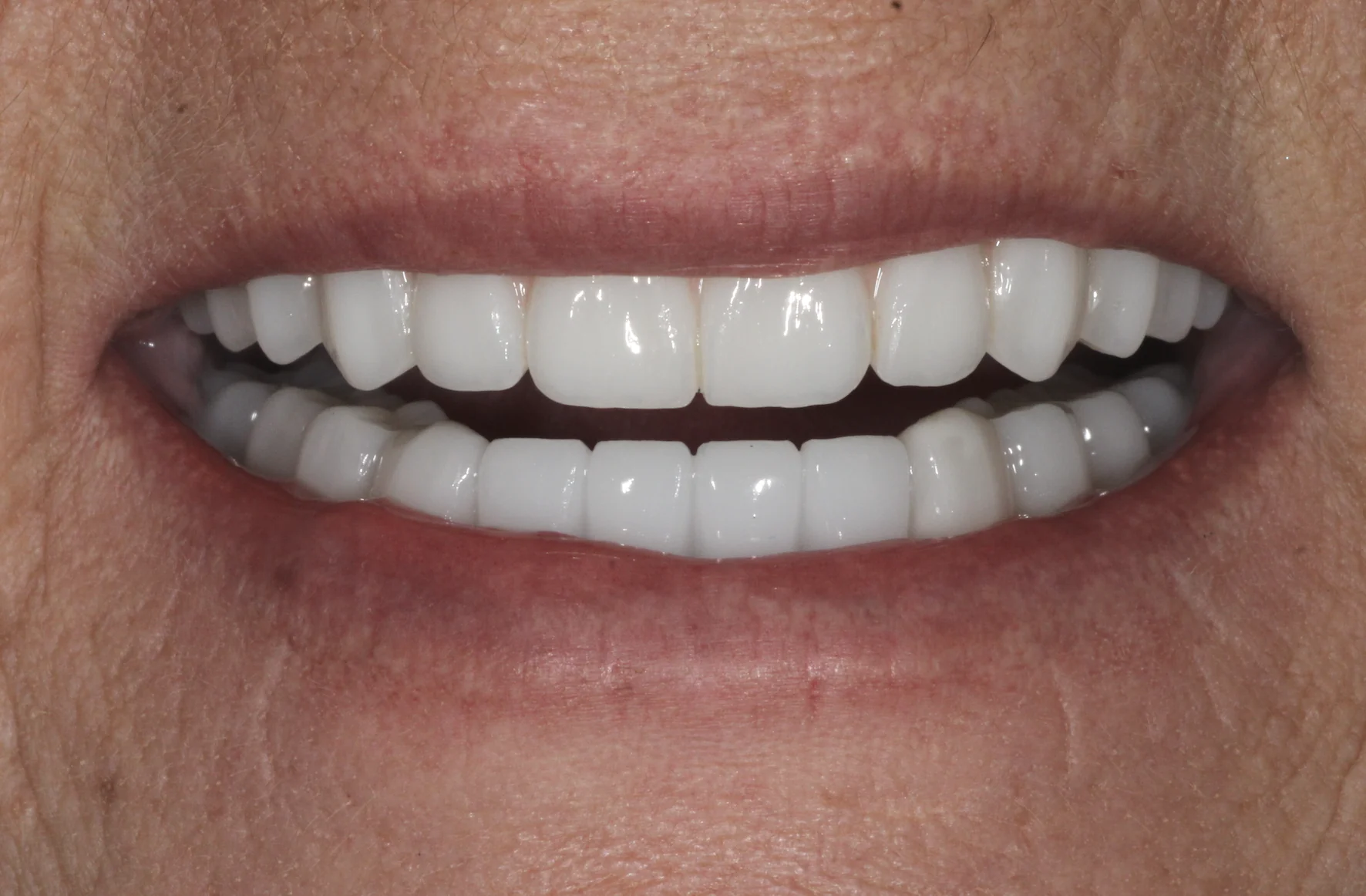 Restored smile after All-on-4 dental implant treatment for advanced gum disease and tooth spacing at Pearl Dental Group in Metairie, LA