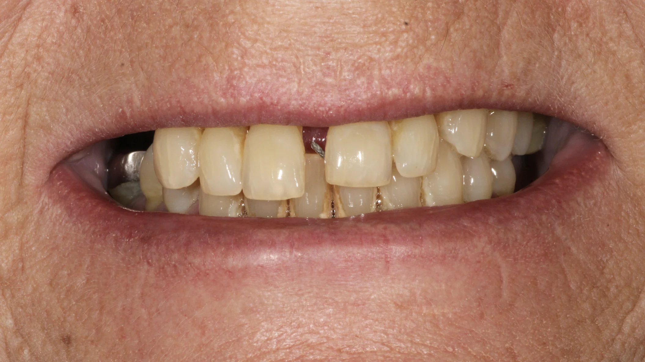 Advanced gum disease and spacing between teeth before All-on-4 dental implant treatment at Pearl Dental Group in Metairie, LA