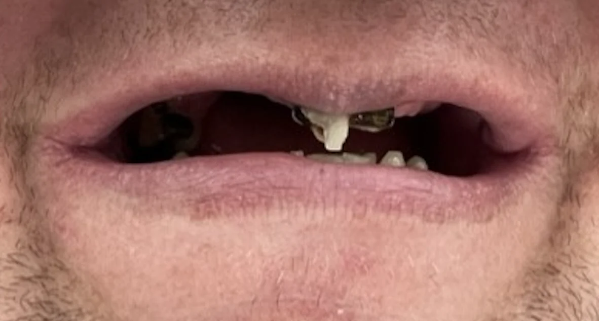 Multiple missing and severely decayed teeth before All-on-4 dental implant treatment at Pearl Dental Group in Metairie, LA