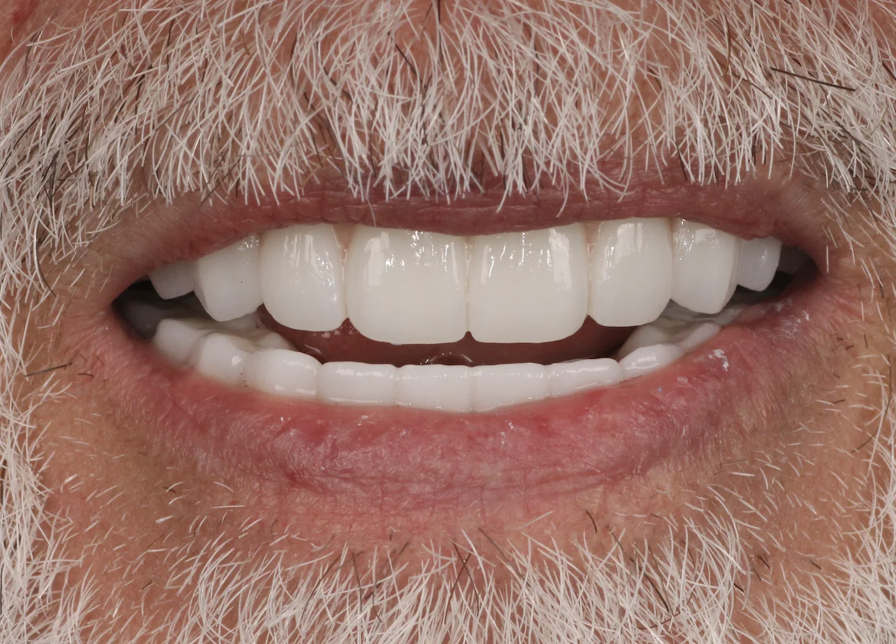 Restored smile after All-on-4 dental implant treatment for advanced gum disease at Pearl Dental Group in Metairie, LA