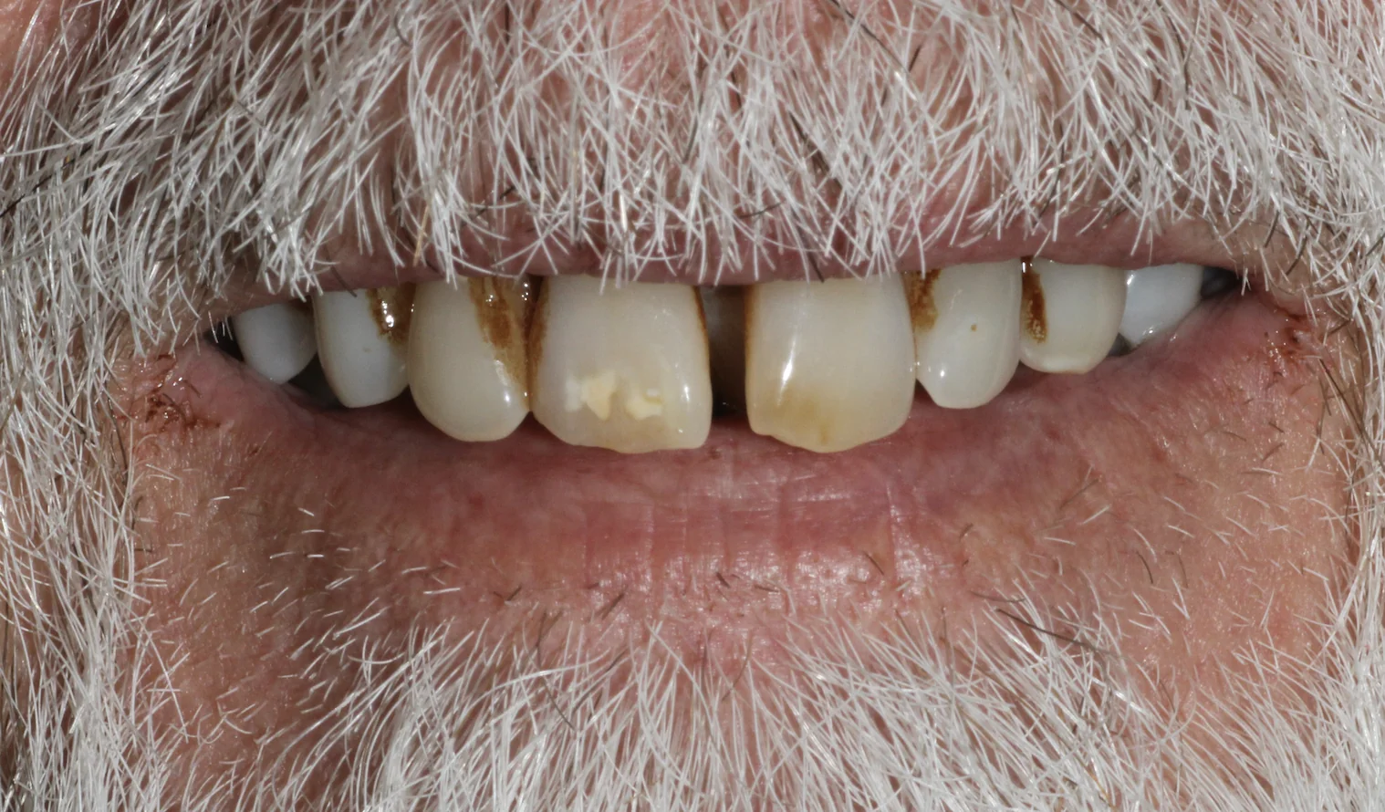 Advanced gum disease before All-on-4 dental implant treatment at Pearl Dental Group in Metairie, LA